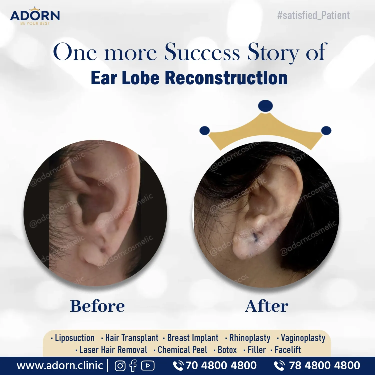 Ear Lobe Reconstruction | Before and After Plastic Surgery Results | Adorn Clinic