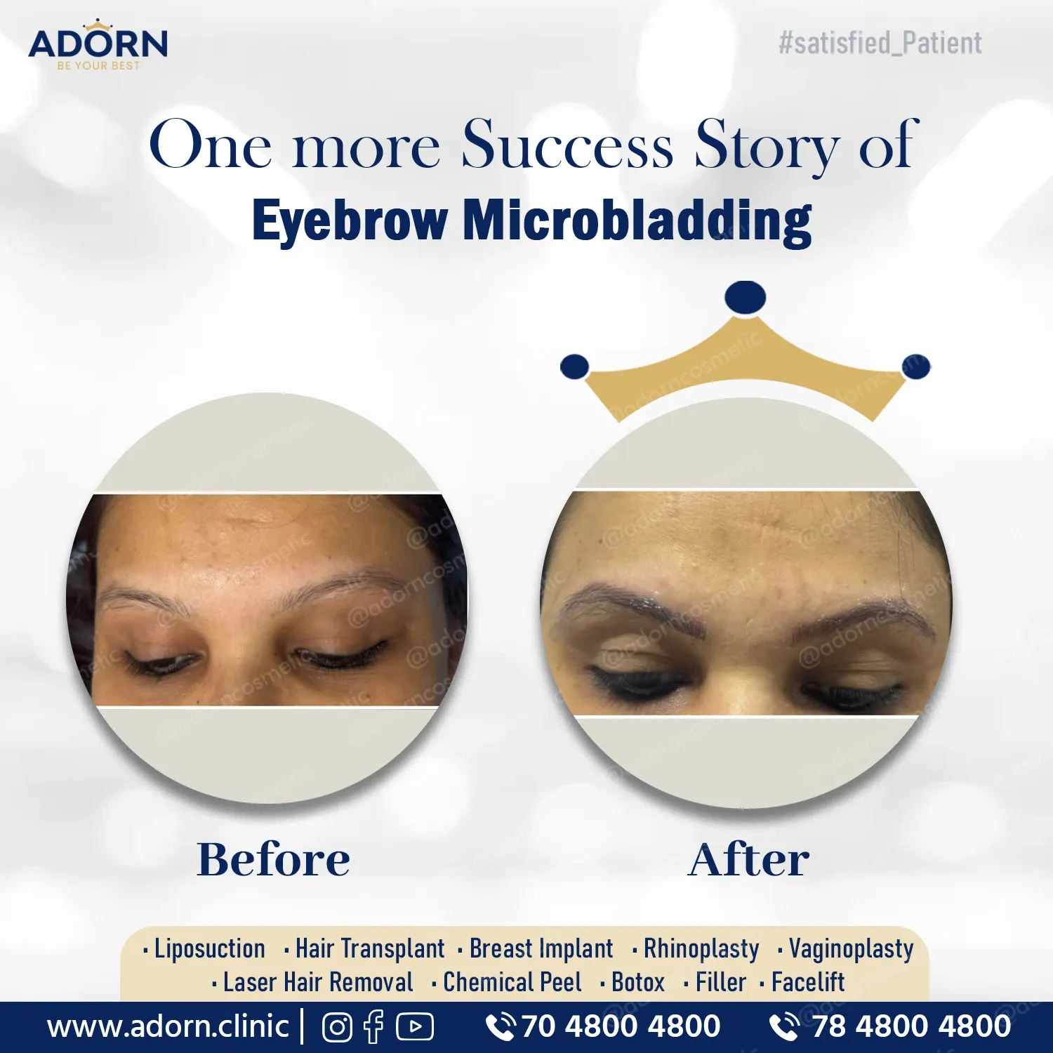 Eyebrow Microblading | Before and After Plastic Surgery Results | Adorn Clinic