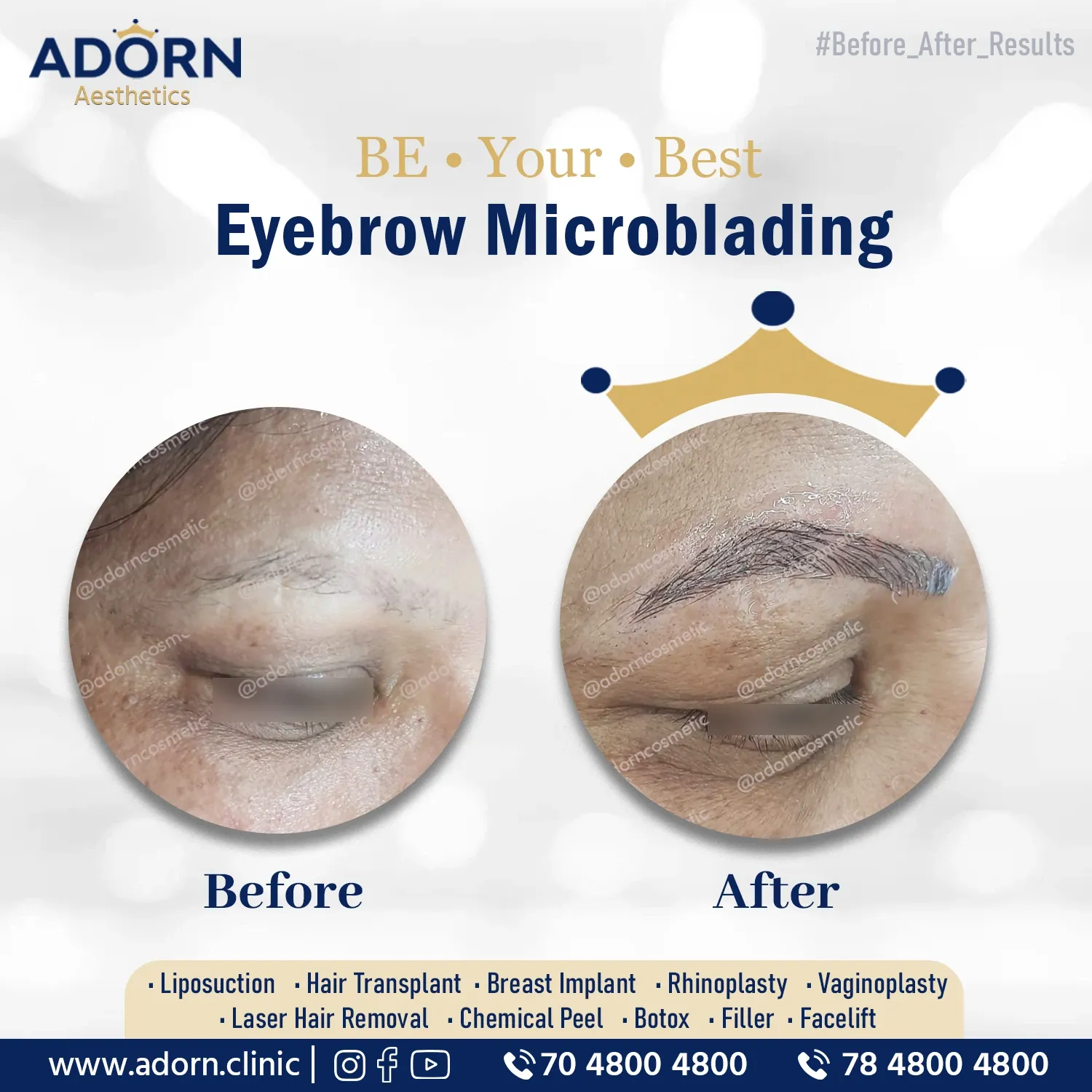 Eyebrow shaping | Before and After Plastic Surgery Results | Adorn Clinic