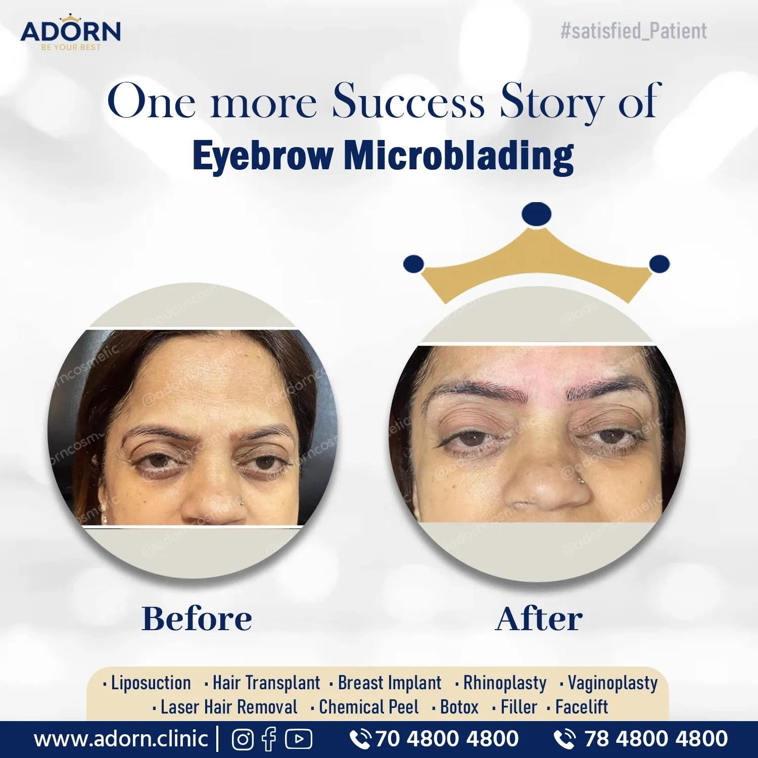 Eyebrow Microblading | Before and After Plastic Surgery Results | Adorn Clinic