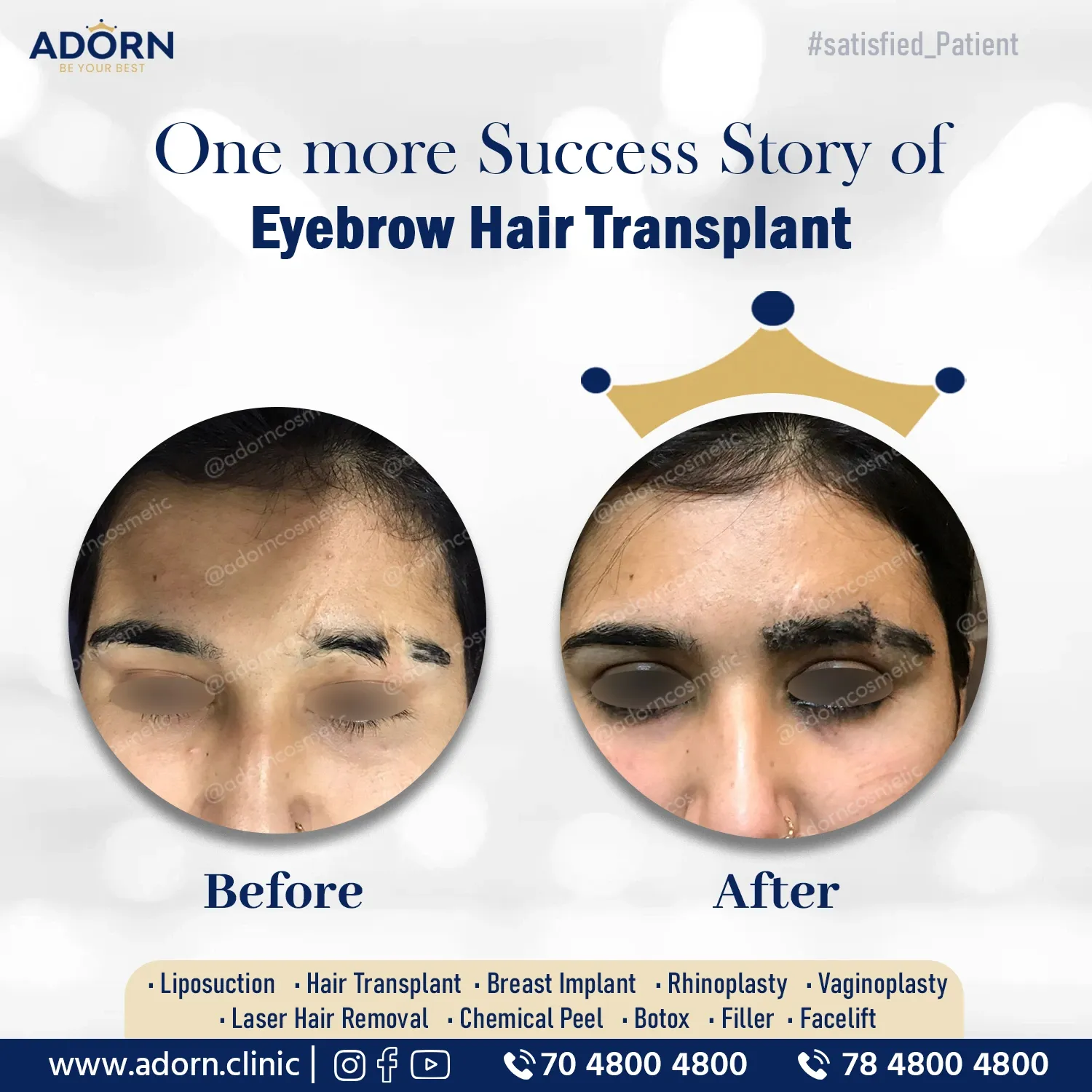 Eyebrow Hair Transplant | Before and After Plastic Surgery Results | Adorn Clinic