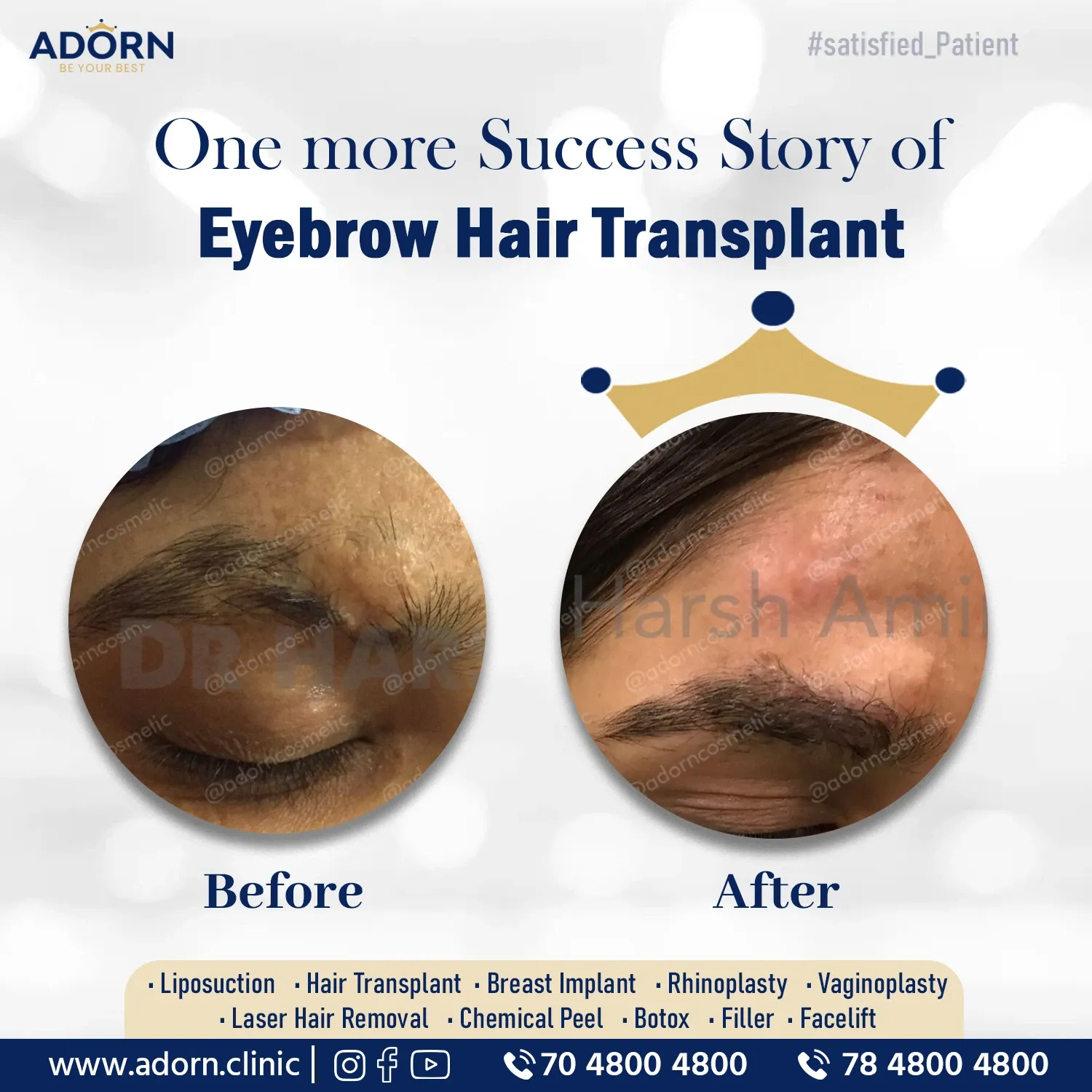 Post Trauma Scar Eyebrow Hair loss | Before and After Plastic Surgery Results | Adorn Clinic