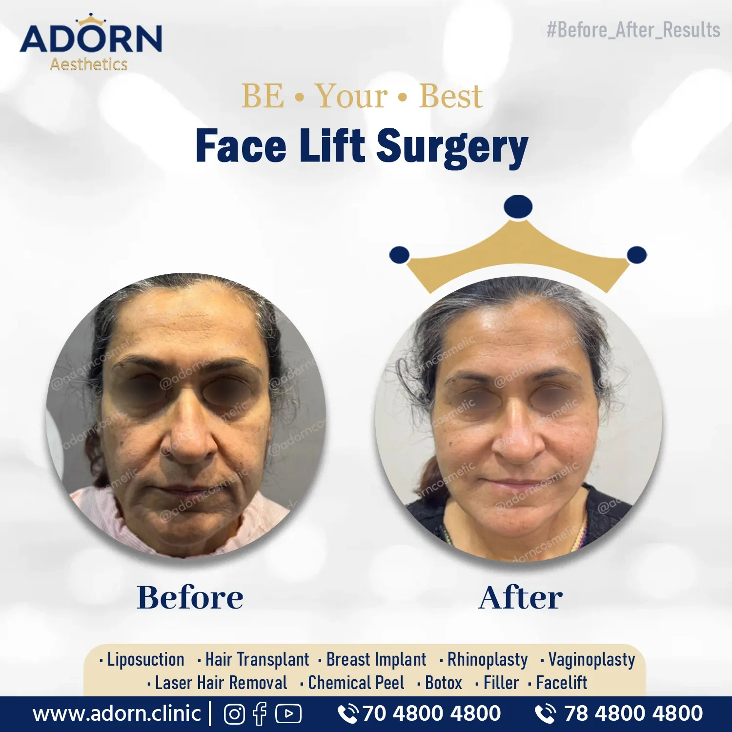 Mid Facelift | Before and After Plastic Surgery Results | Adorn Clinic