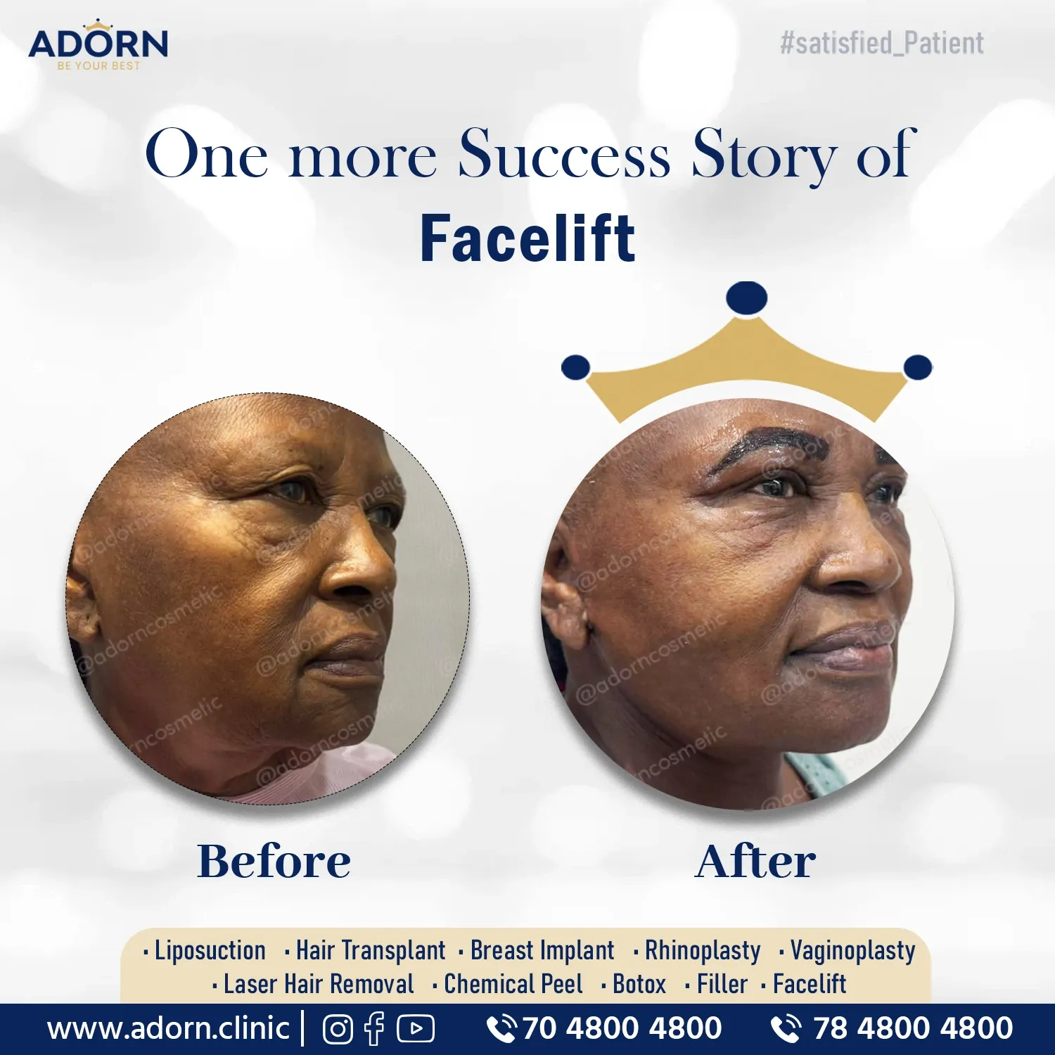 Lower face + neck Lift + Blepharoplasty | Before and After Plastic Surgery Results | Adorn Clinic