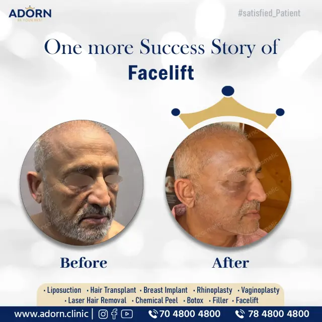 Mid Face Lift + Lower Facelift + Blepharoplasty | Before and After Plastic Surgery Results | Adorn Clinic
