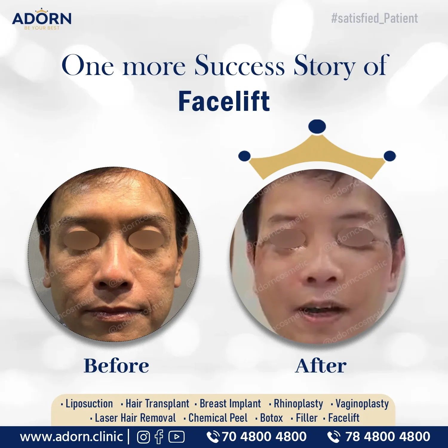 Face Lift