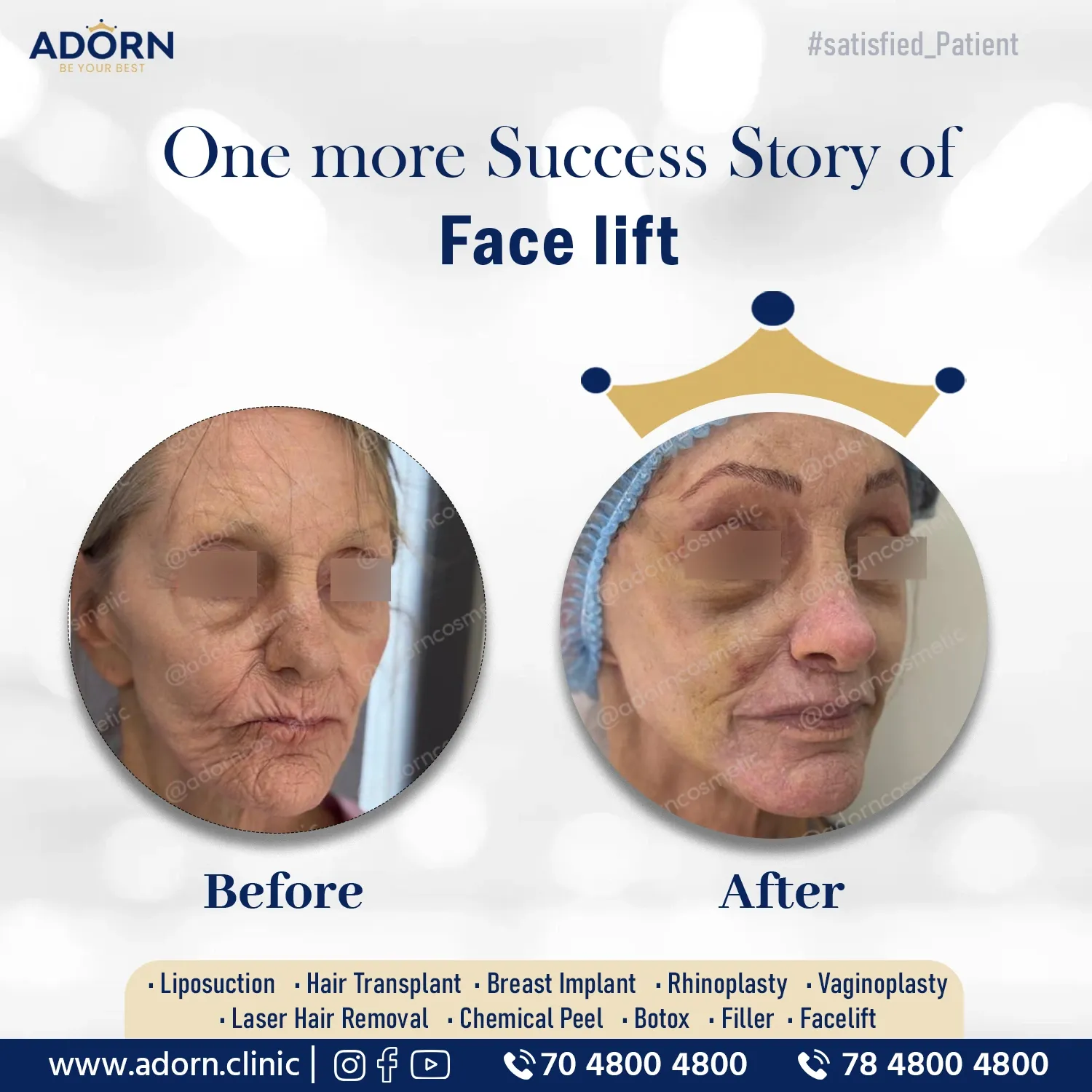 Face lift Surgery | Before and After Plastic Surgery Results | Adorn Clinic