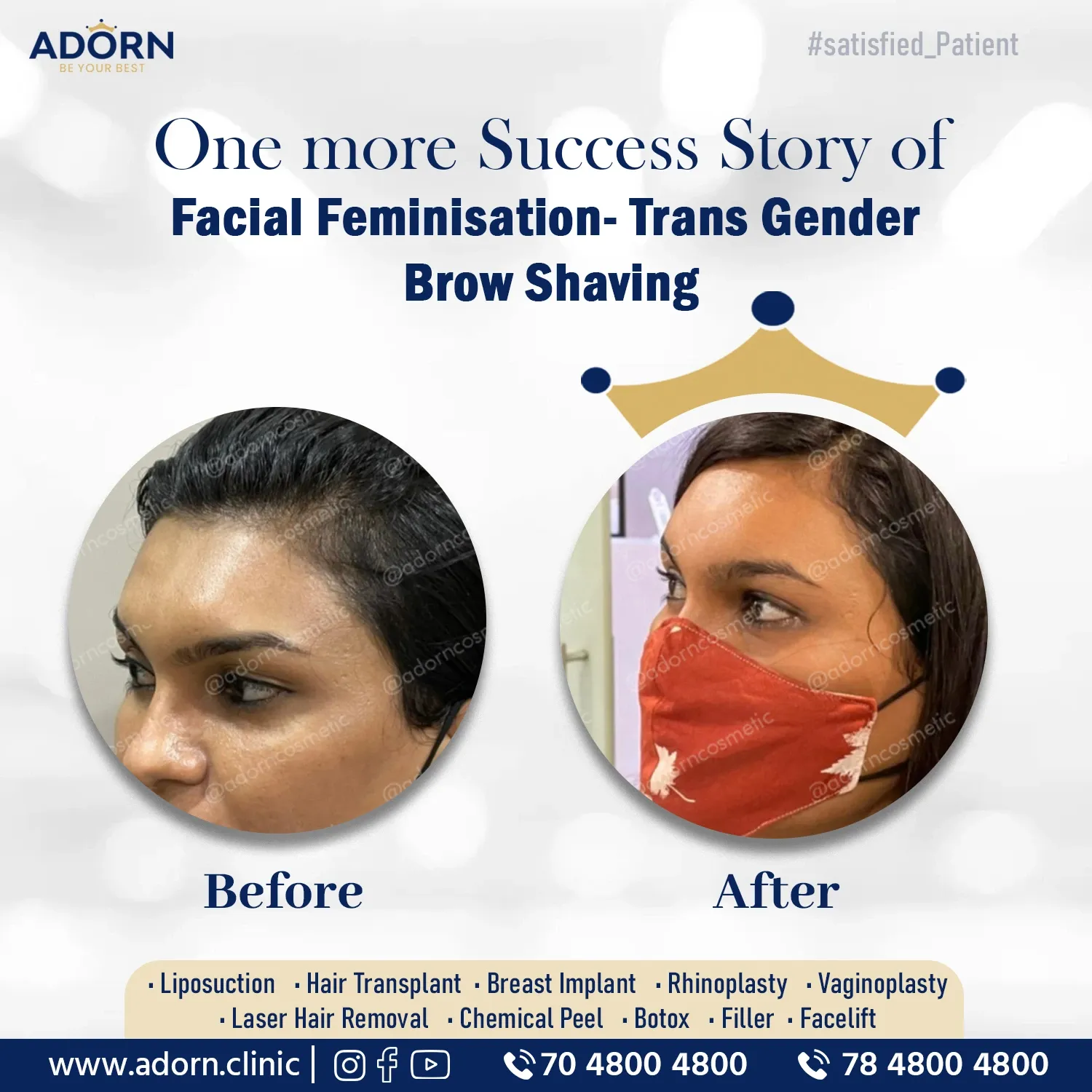 Facial feminisation | Before and After Plastic Surgery Results | Adorn Clinic