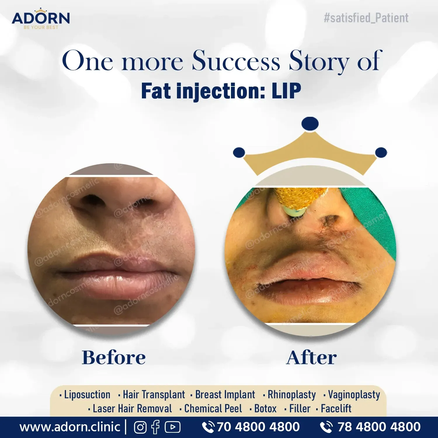 Fat injection in lips | Before and After Plastic Surgery Results | Adorn Clinic