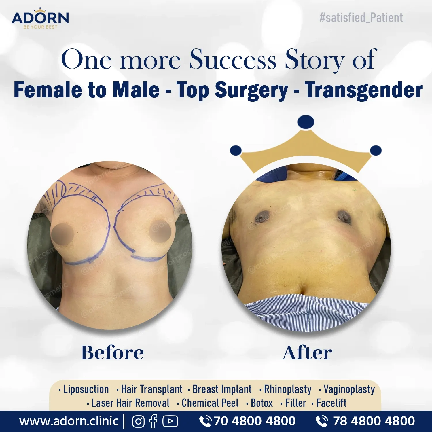 Trans Male Top Surgery | Before and After Plastic Surgery Results | Adorn Clinic