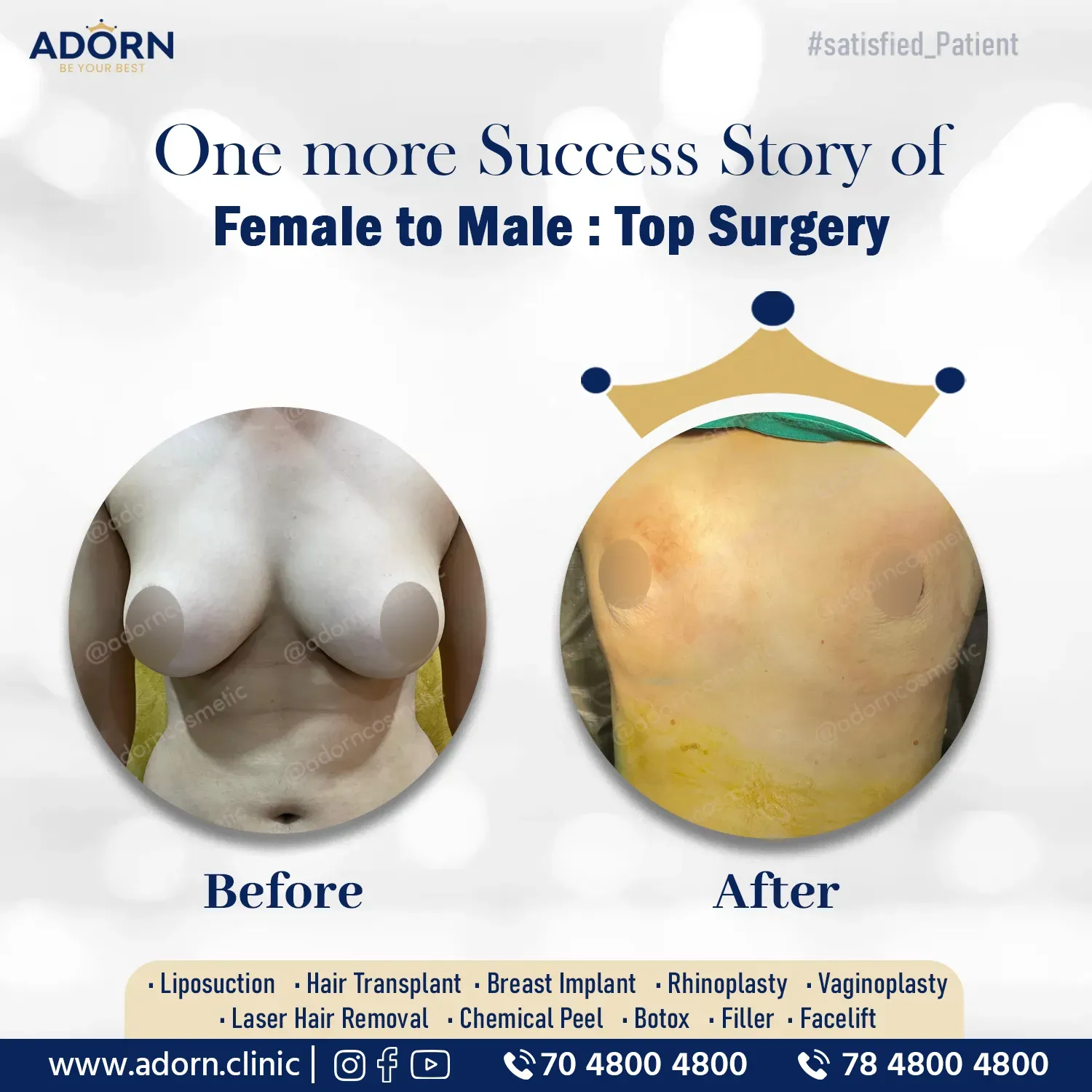 Transgender Top Key Hole Surgery | Before and After Plastic Surgery Results | Adorn Clinic