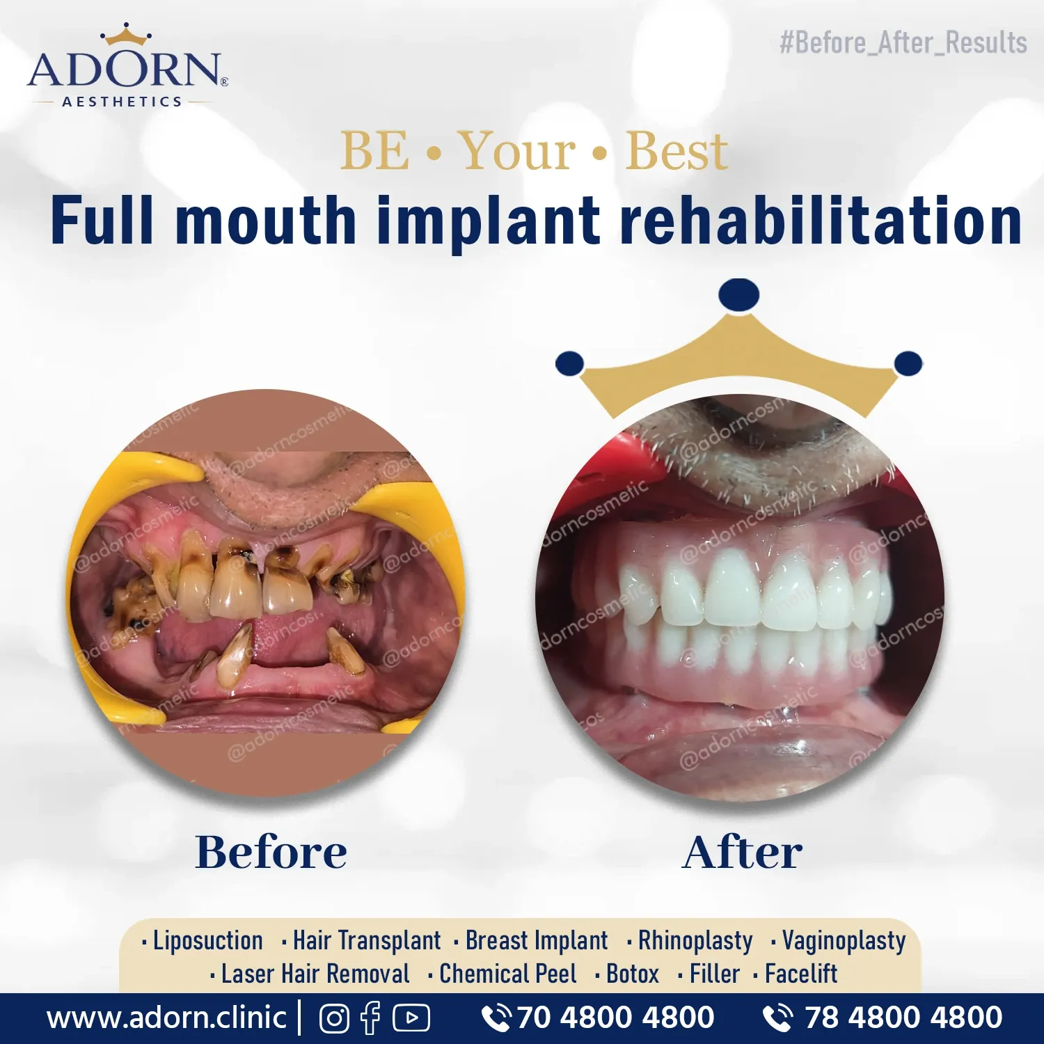 Dental Rehabilitation | Before and After Plastic Surgery Results | Adorn Clinic