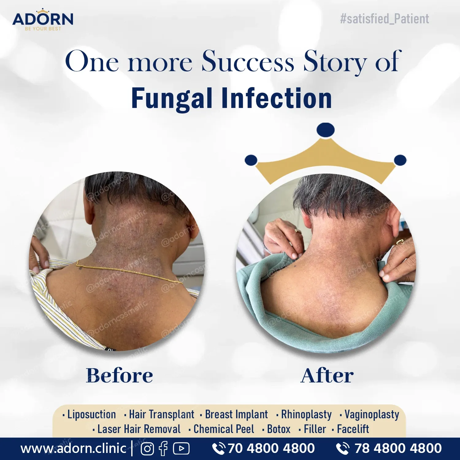 Fungal Infestation | Before and After Plastic Surgery Results | Adorn Clinic