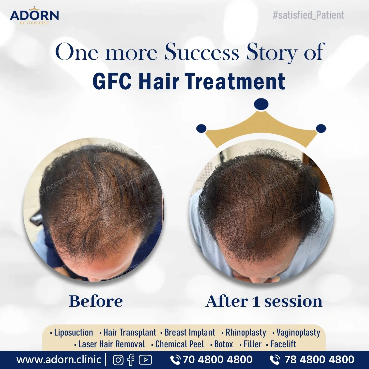 Hair Thinning | Before and After Plastic Surgery Results | Adorn Clinic