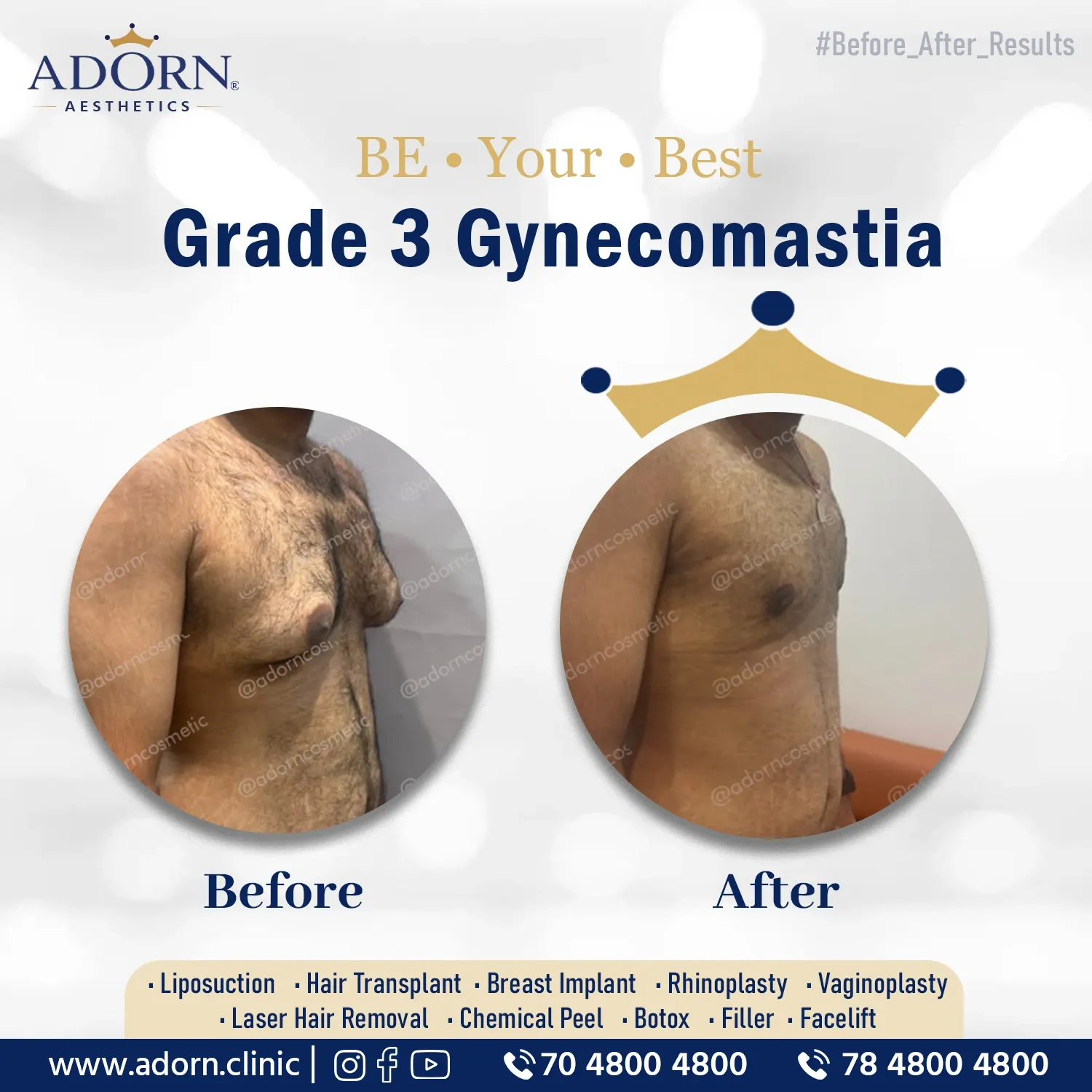 Grade 3 Gynecomastia | Before and After Plastic Surgery Results | Adorn Clinic