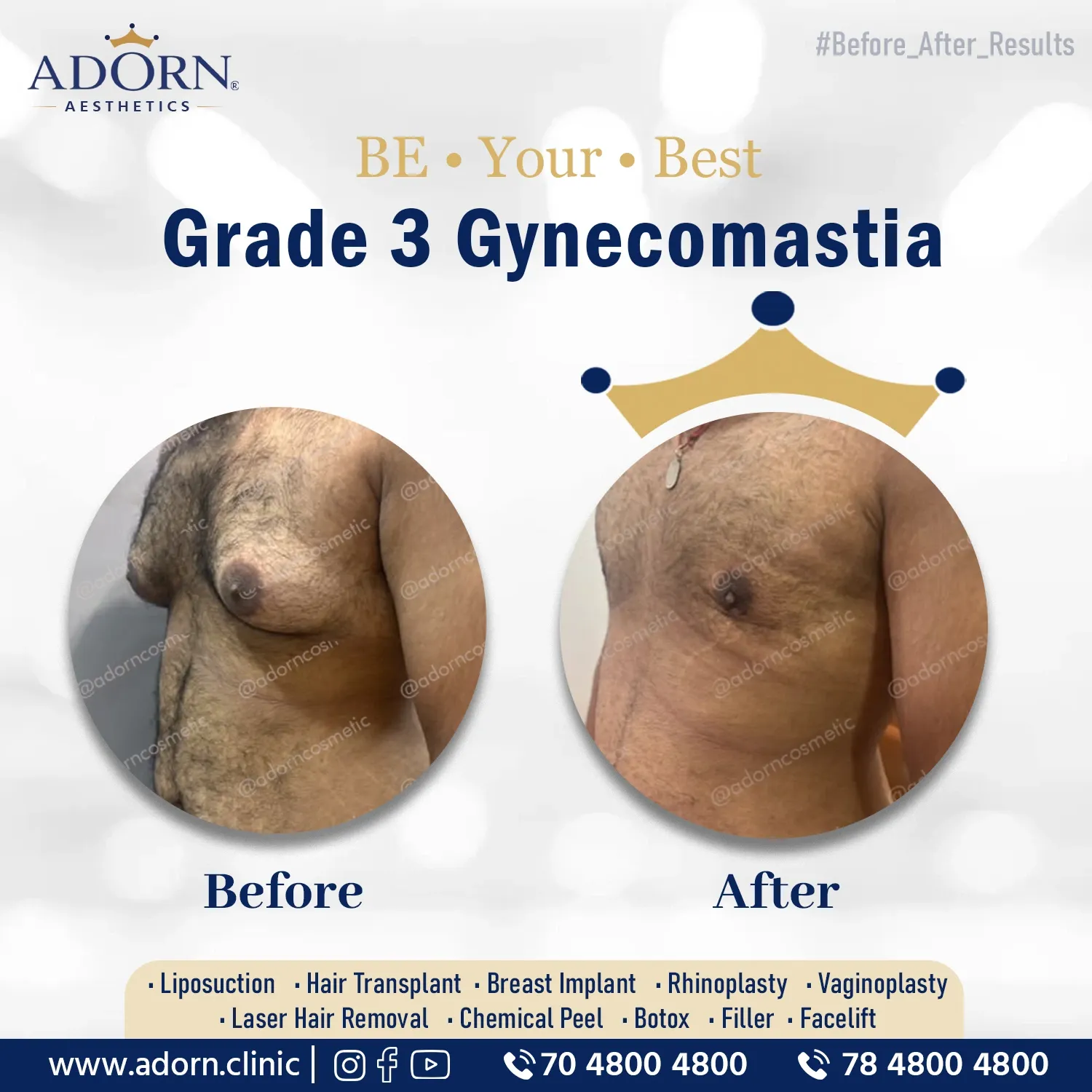 Grade 3 Gynecomastia | Before and After Plastic Surgery Results | Adorn Clinic