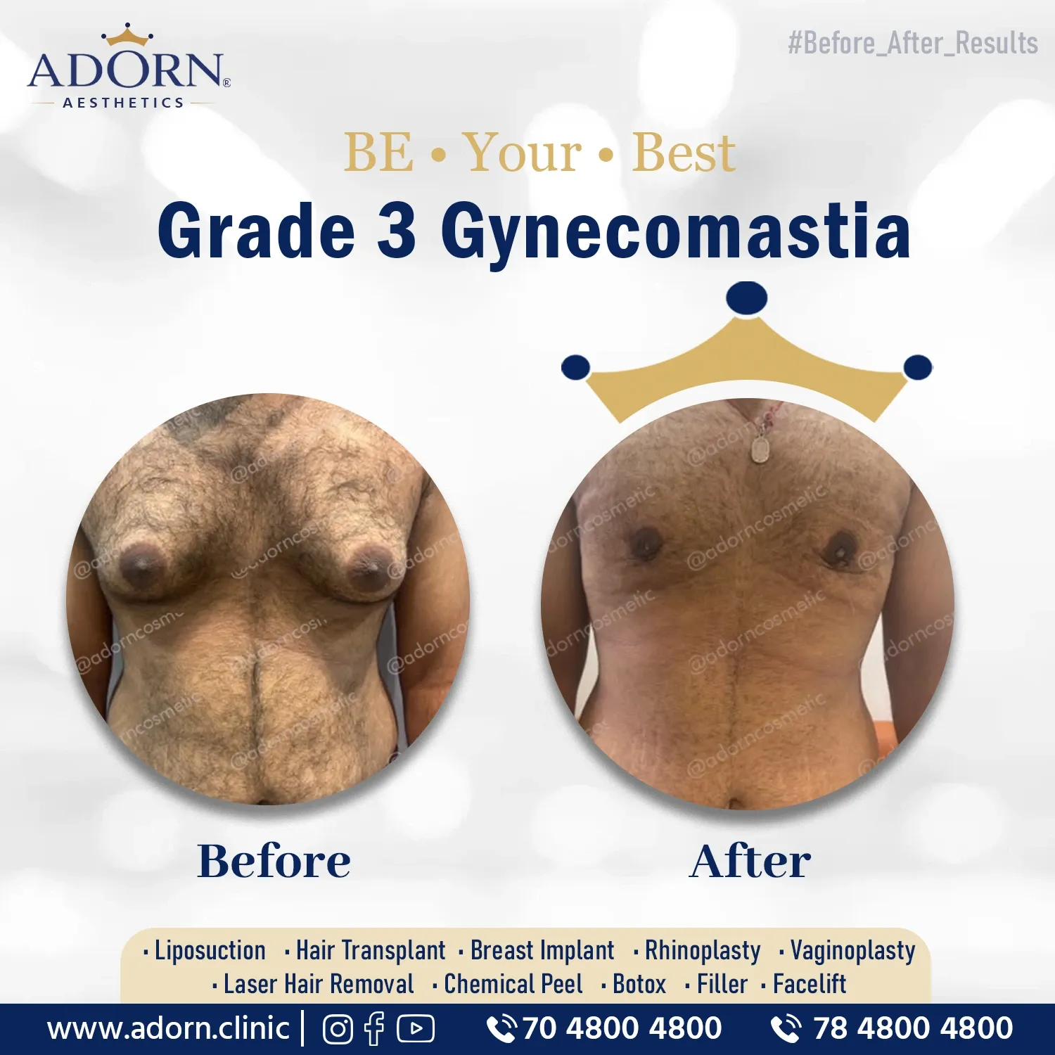 Grade 3 Gynecomastia | Before and After Plastic Surgery Results | Adorn Clinic