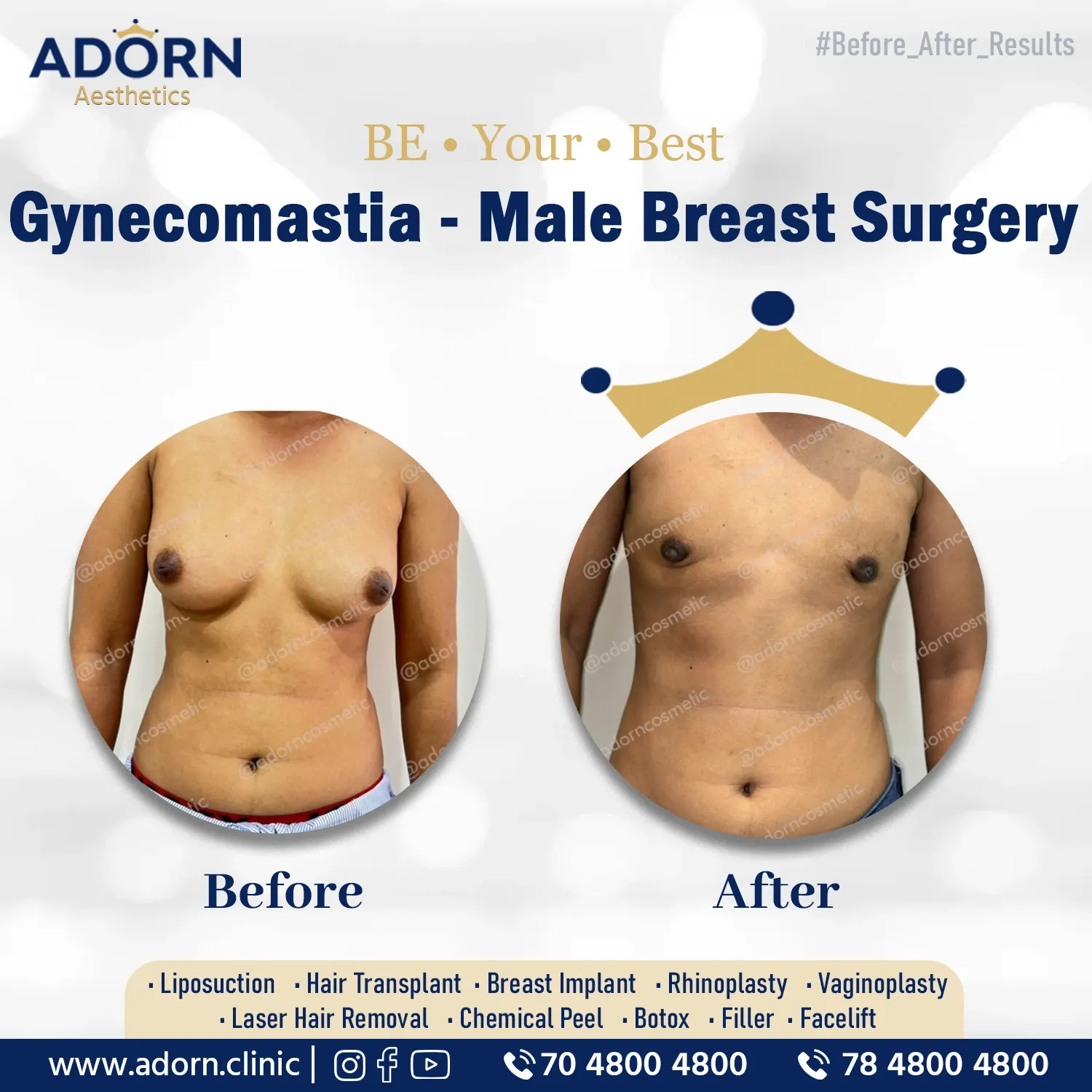 Grade 3 Gynecomastia | Before and After Plastic Surgery Results | Adorn Clinic
