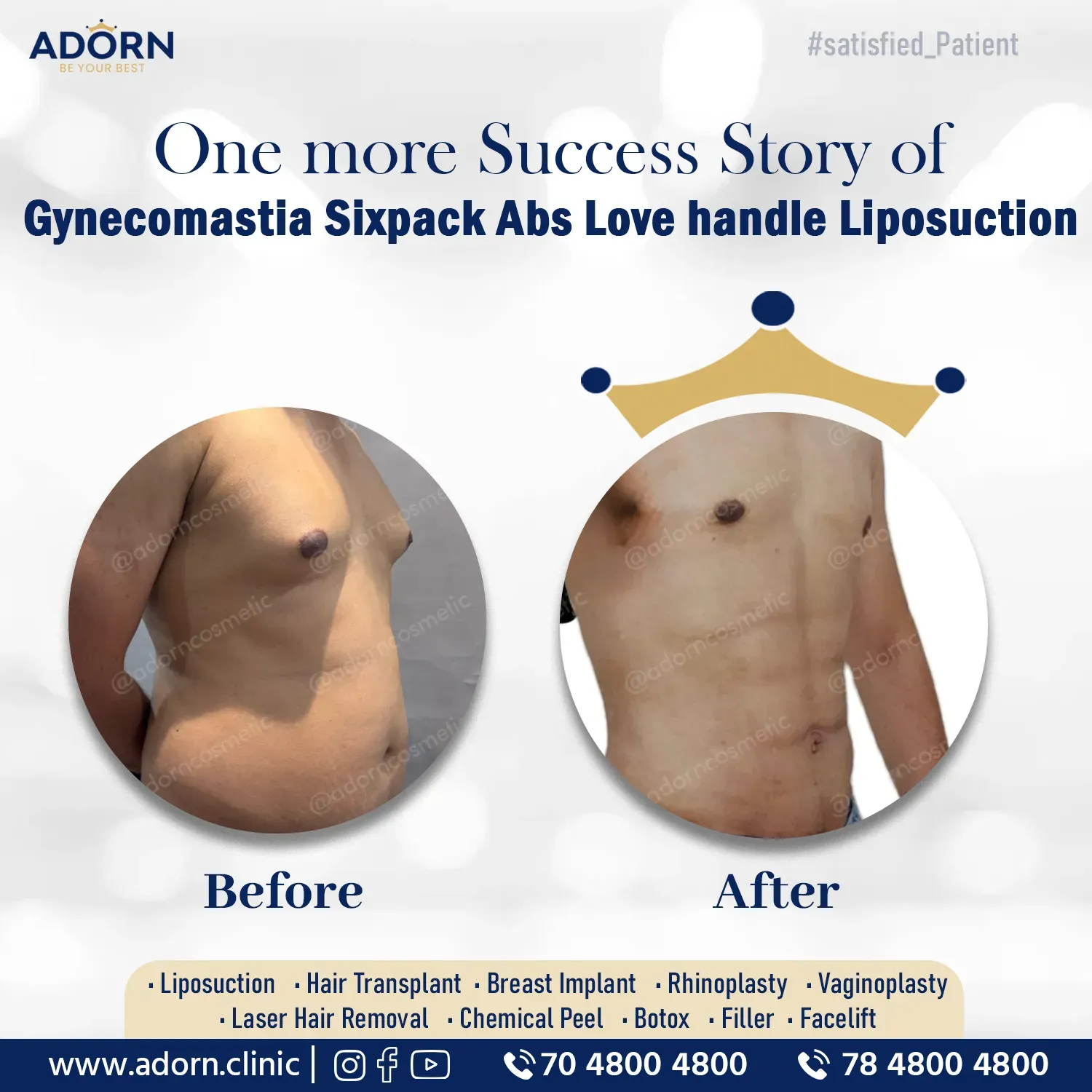Grade 1 Gynecomastia + six pack abs + love Handle Correction | Before and After Plastic Surgery Results | Adorn Clinic