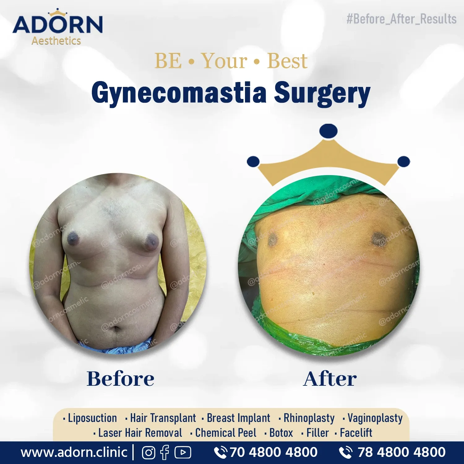 Gynecomastia