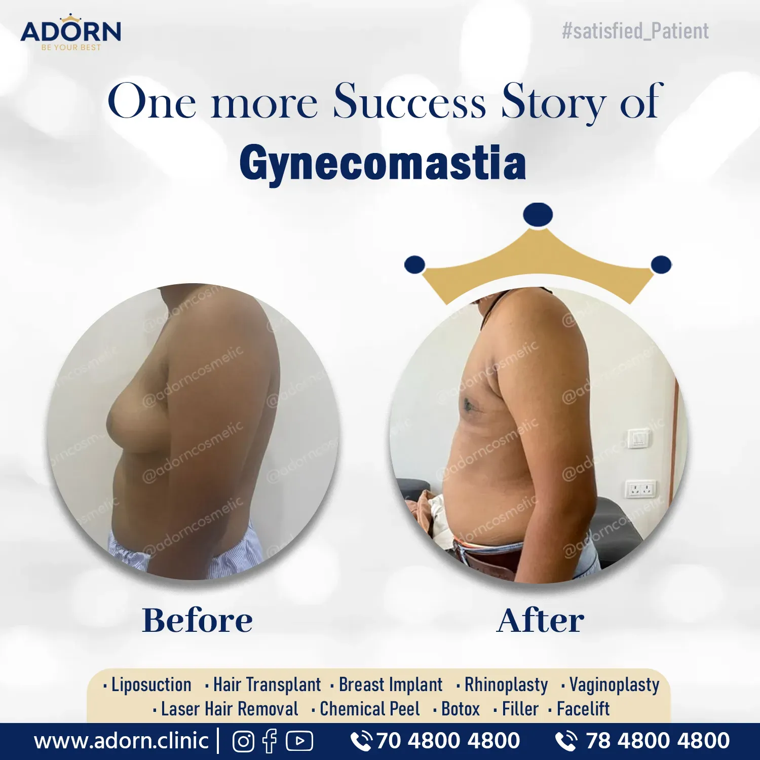 Grade 3 male breast surgery | Before and After Plastic Surgery Results | Adorn Clinic