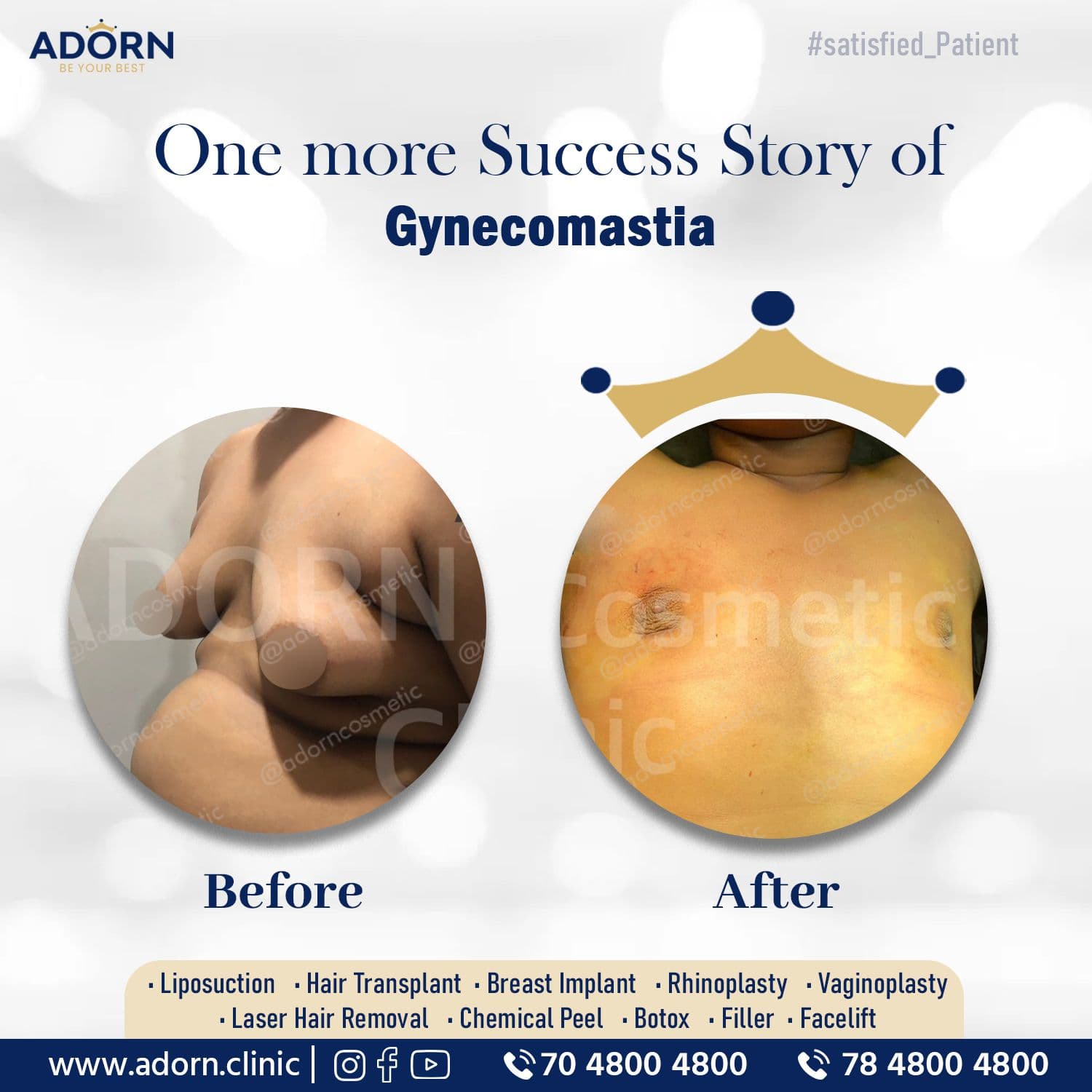Grade 3 Gynecomastia | Before and After Plastic Surgery Results | Adorn Clinic
