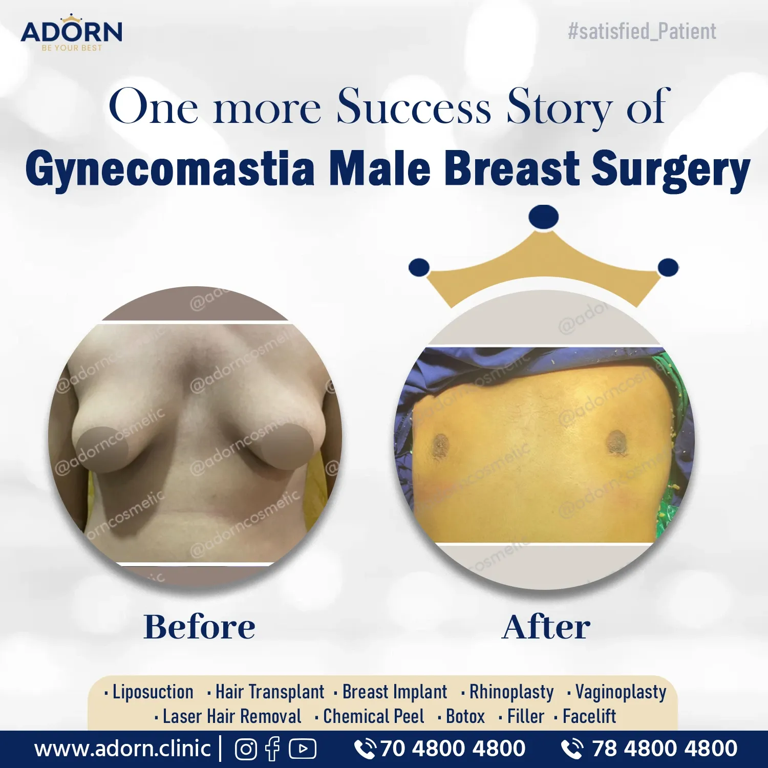 Gynecomastia grade 3 | Before and After Plastic Surgery Results | Adorn Clinic