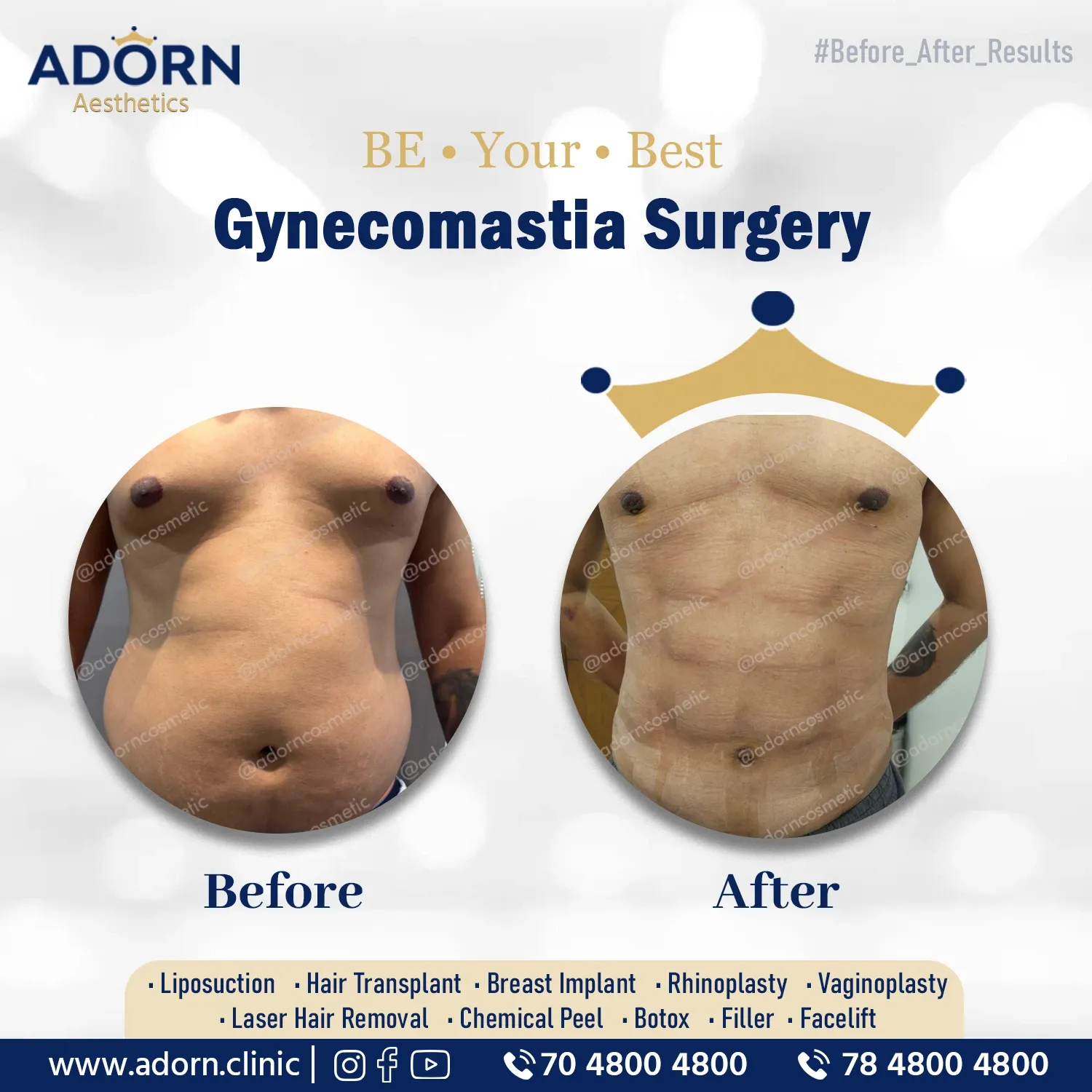 Grade 2 Gynecomastia | Before and After Plastic Surgery Results | Adorn Clinic