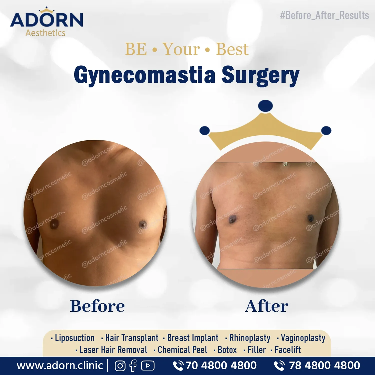 Male breast surgery grade 1 | Before and After Plastic Surgery Results | Adorn Clinic