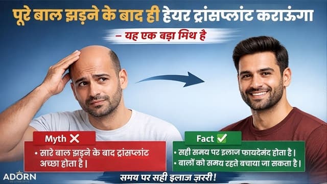 पूरे बाल झड़ जाने के बाद ही हेयर ट्रांसप्लांट कराऊंगा” – यह एक बड़ा मिथ है पूरे बाल झड़ जाने के बाद ही हेयर ट्रांसप्लांट कराऊंगा” – यह एक बड़ा मिथ है