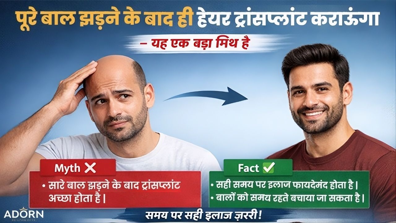 पूरे बाल झड़ जाने के बाद ही हेयर ट्रांसप्लांट” – Myth Hair transplant myths