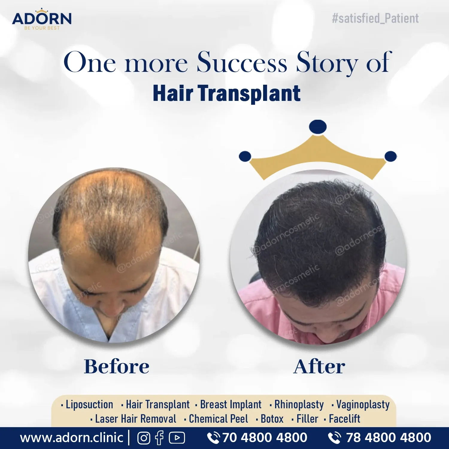 Hair Transplant