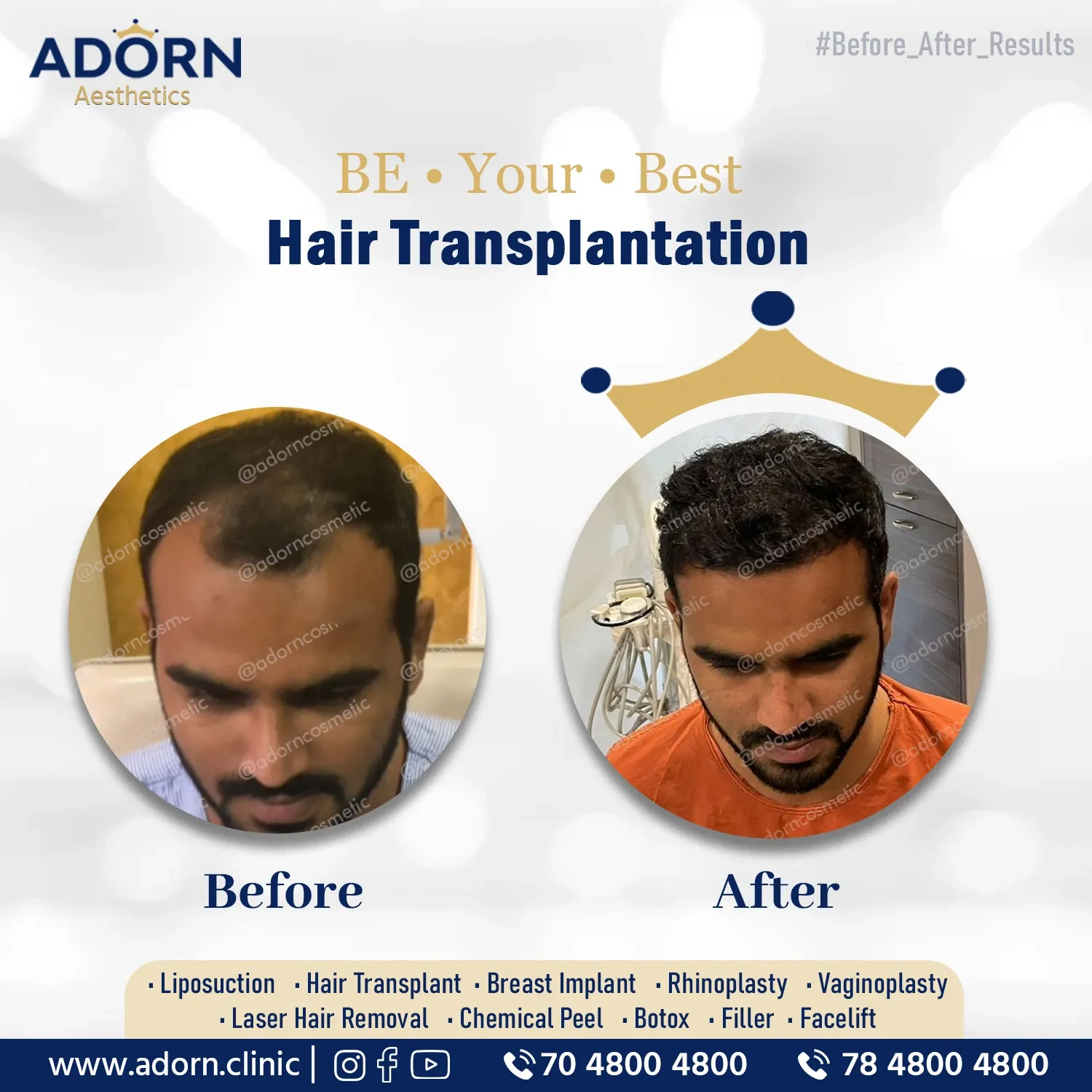 Grade 2 Baldness | Before and After Plastic Surgery Results | Adorn Clinic