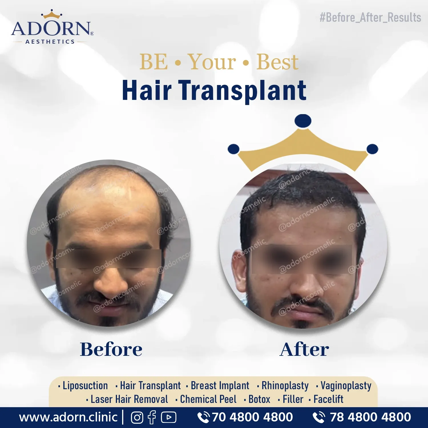 Grade 6 baldness | Before and After Plastic Surgery Results | Adorn Clinic