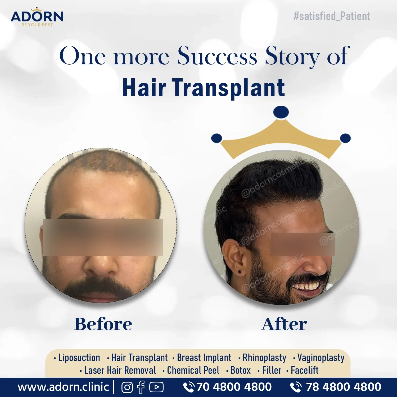 Grade 4 Hair Transplant | Before and After Plastic Surgery Results | Adorn Clinic