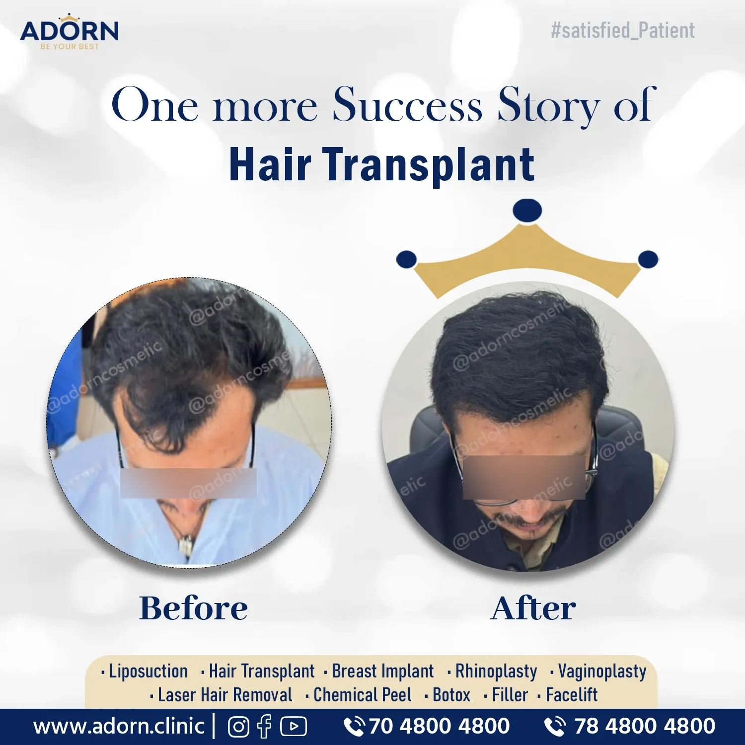 Grade 2 Baldness Transplant | Before and After Plastic Surgery Results | Adorn Clinic