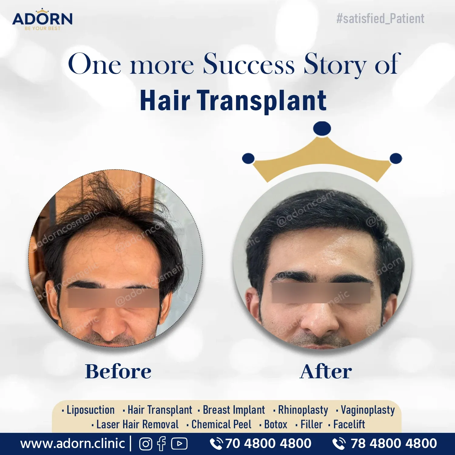 Grade 3 baldness | Before and After Plastic Surgery Results | Adorn Clinic