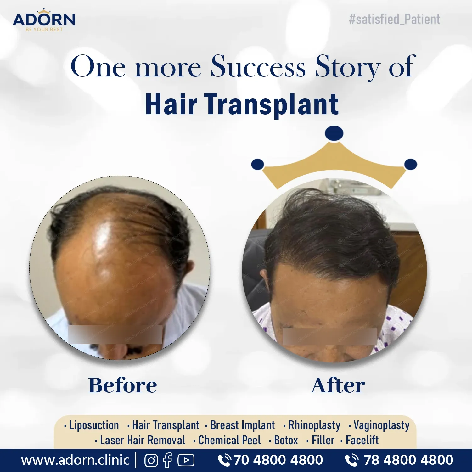 Grade 6 Hair Transplant | Before and After Plastic Surgery Results | Adorn Clinic