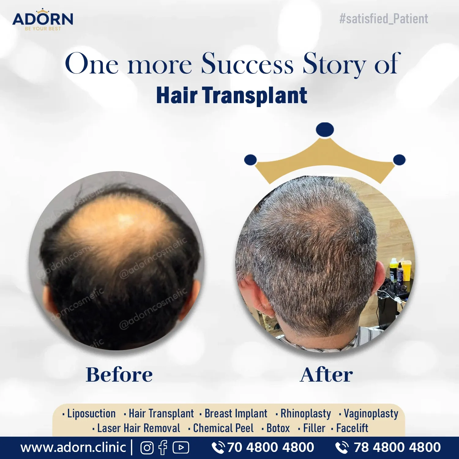 Vertex Crown Hair Transplantation | Before and After Plastic Surgery Results | Adorn Clinic