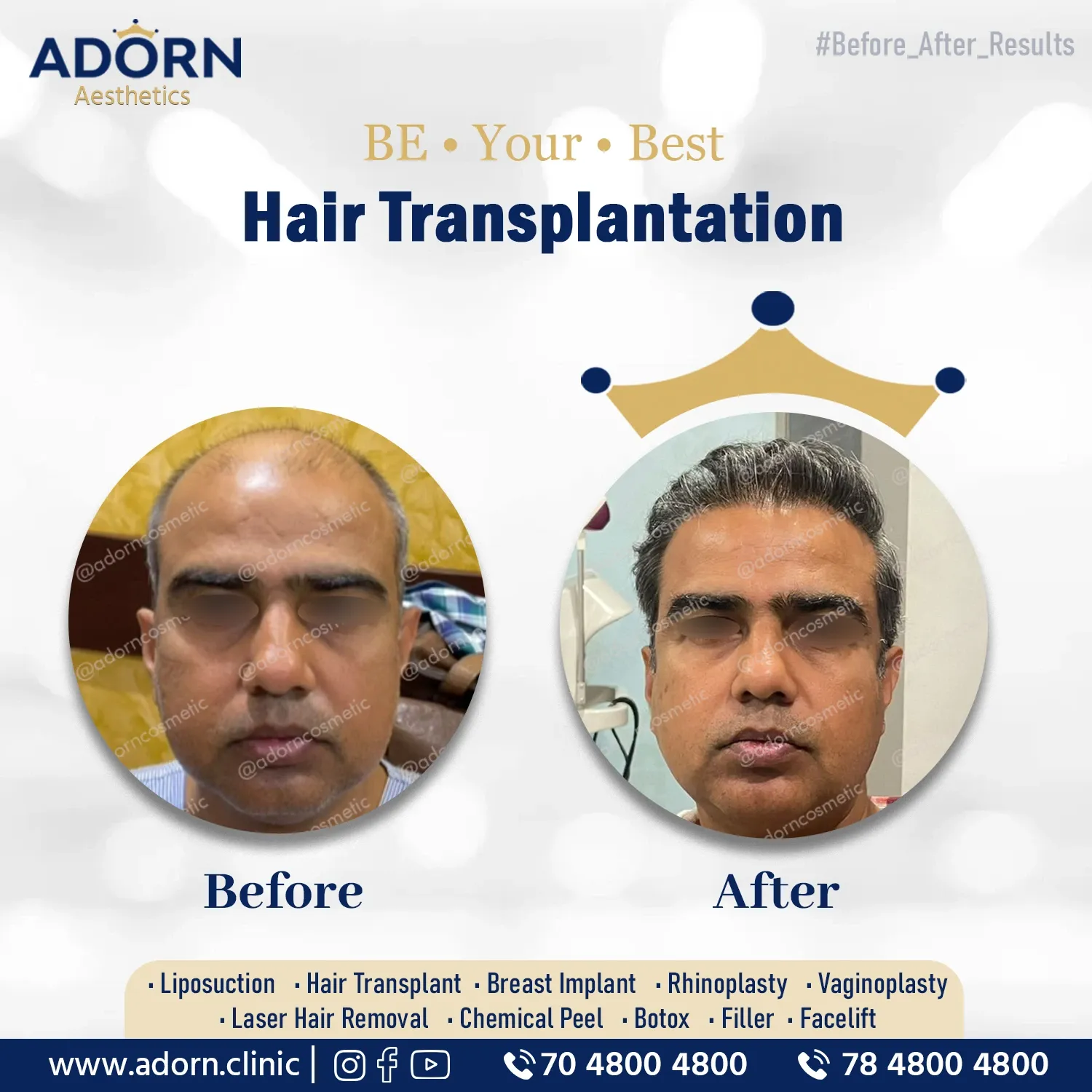 Grade 6 Baldness | Before and After Plastic Surgery Results | Adorn Clinic