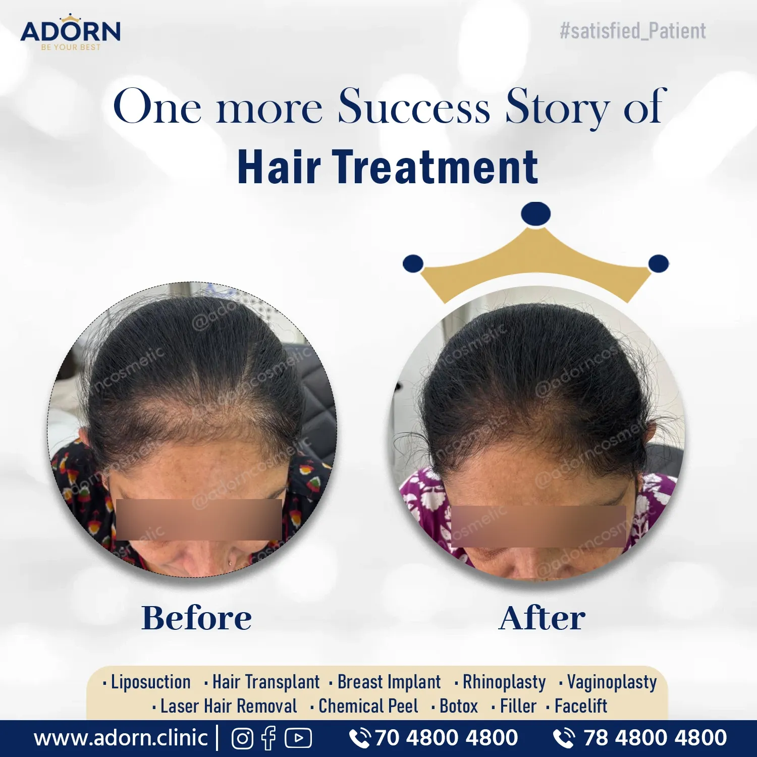 Prp Treatment | Before and After Plastic Surgery Results | Adorn Clinic