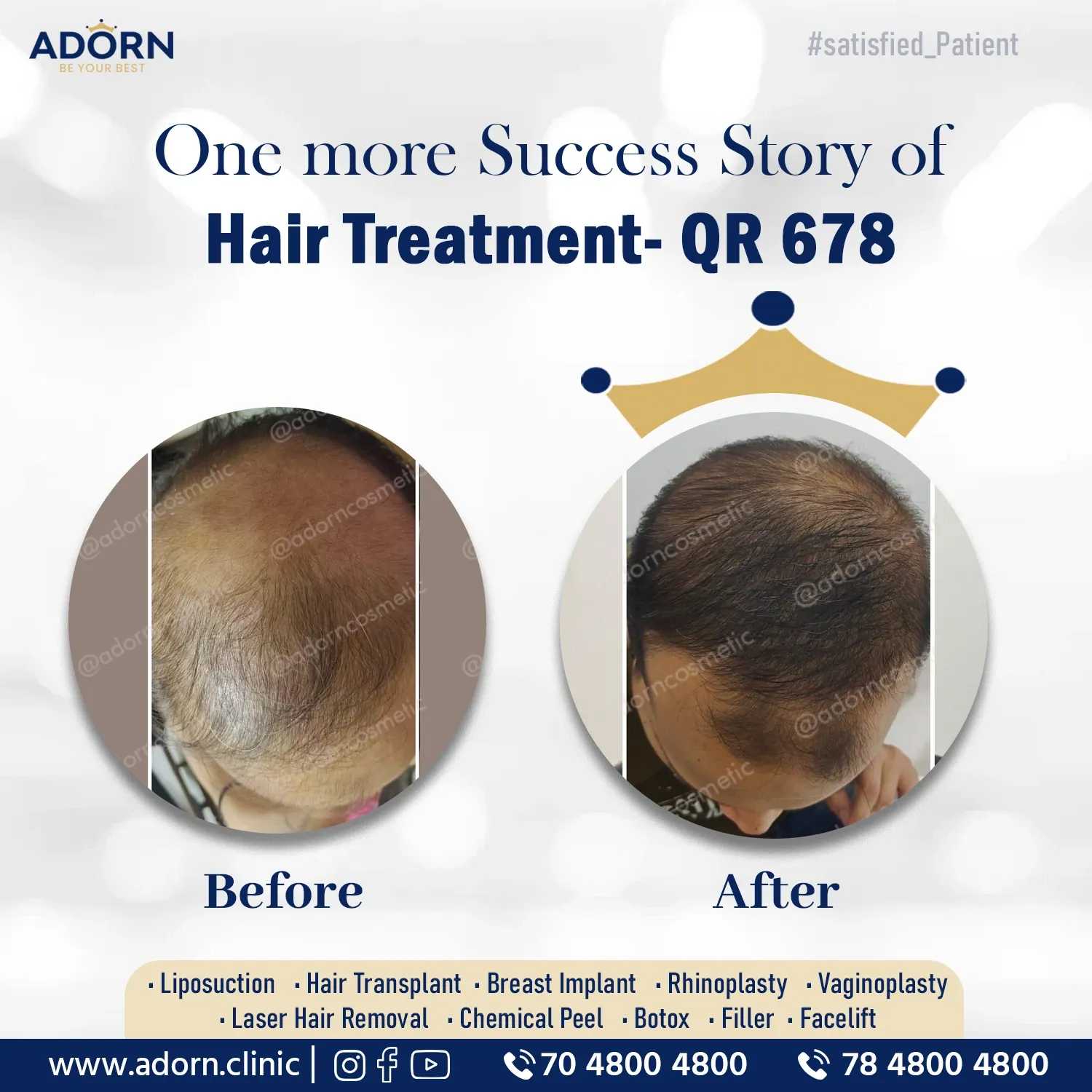 Qr678 | Before and After Plastic Surgery Results | Adorn Clinic