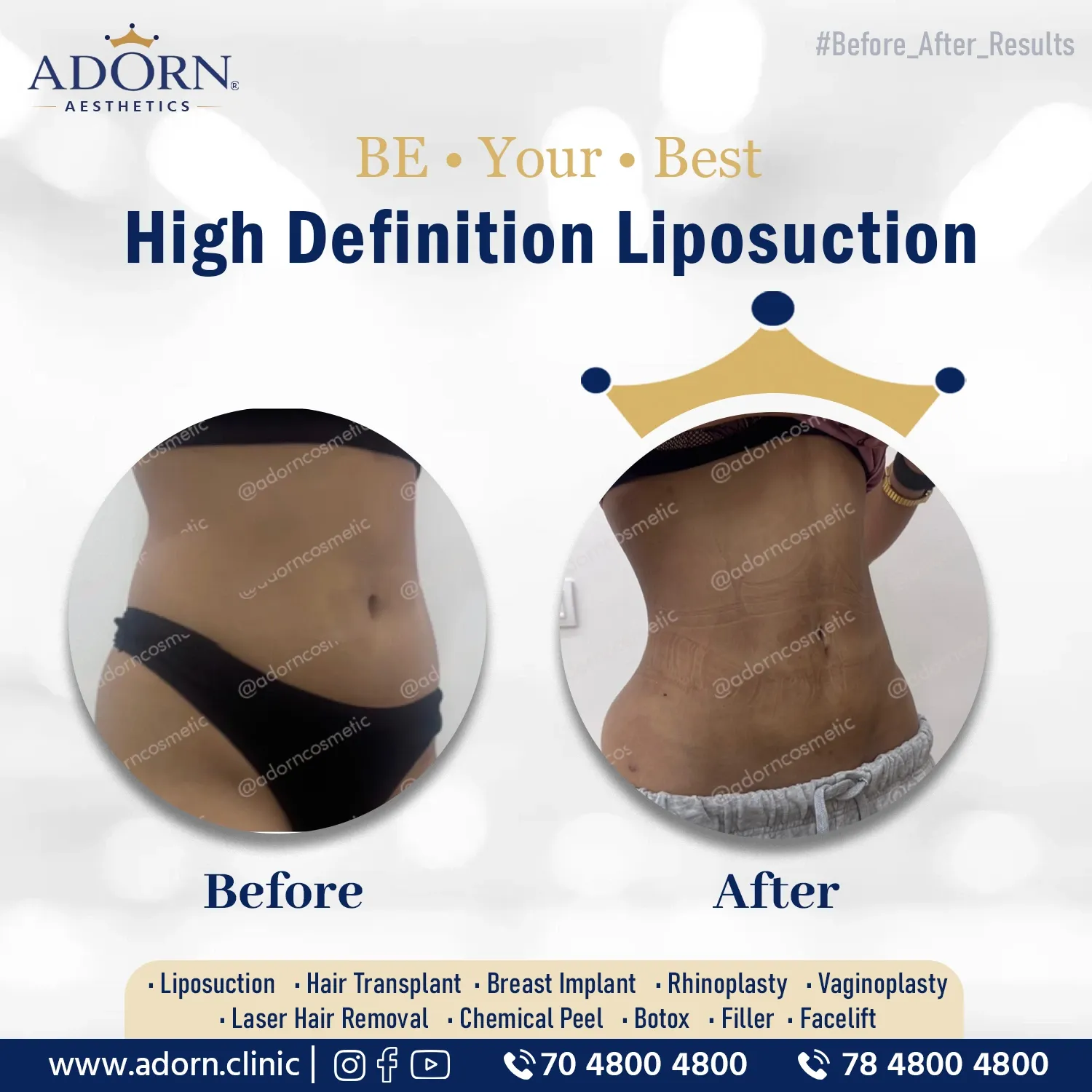 Abdominal Etching | Before and After Plastic Surgery Results | Adorn Clinic