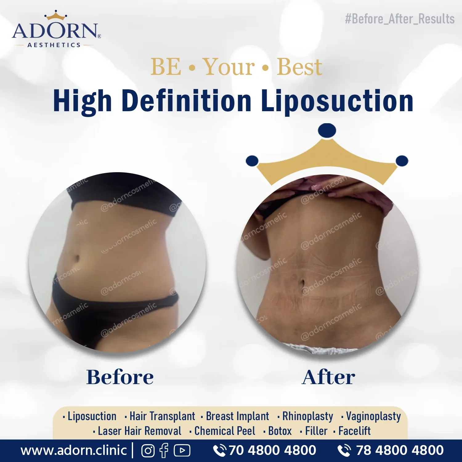 HD liposuction | Before and After Plastic Surgery Results | Adorn Clinic