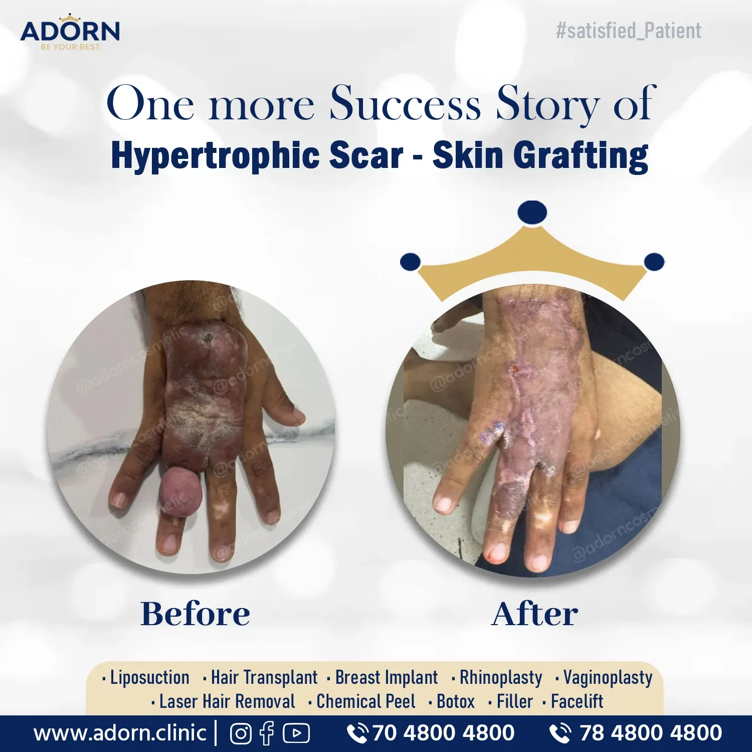 Post Burn Plastic Surgery | Before and After Plastic Surgery Results | Adorn Clinic