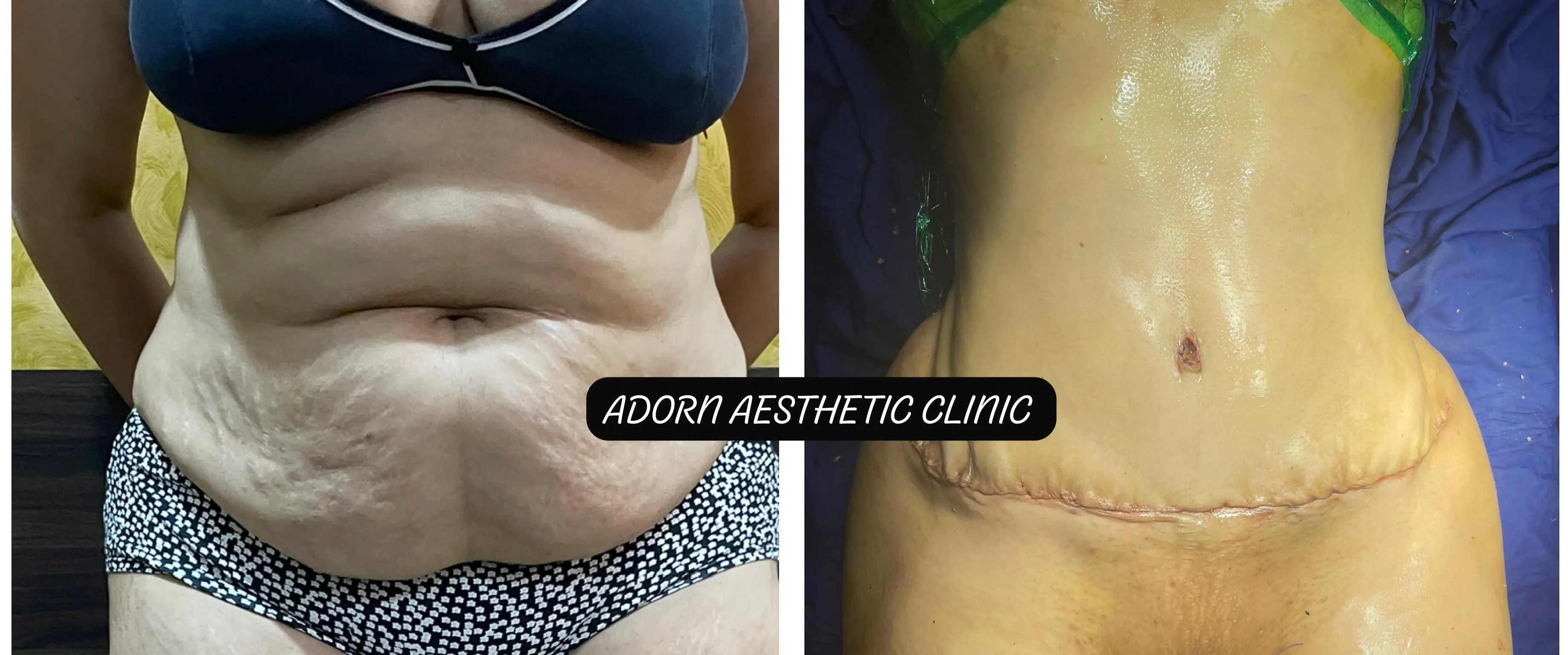 TummyTuck | Before and After Plastic Surgery Results | Adorn Clinic