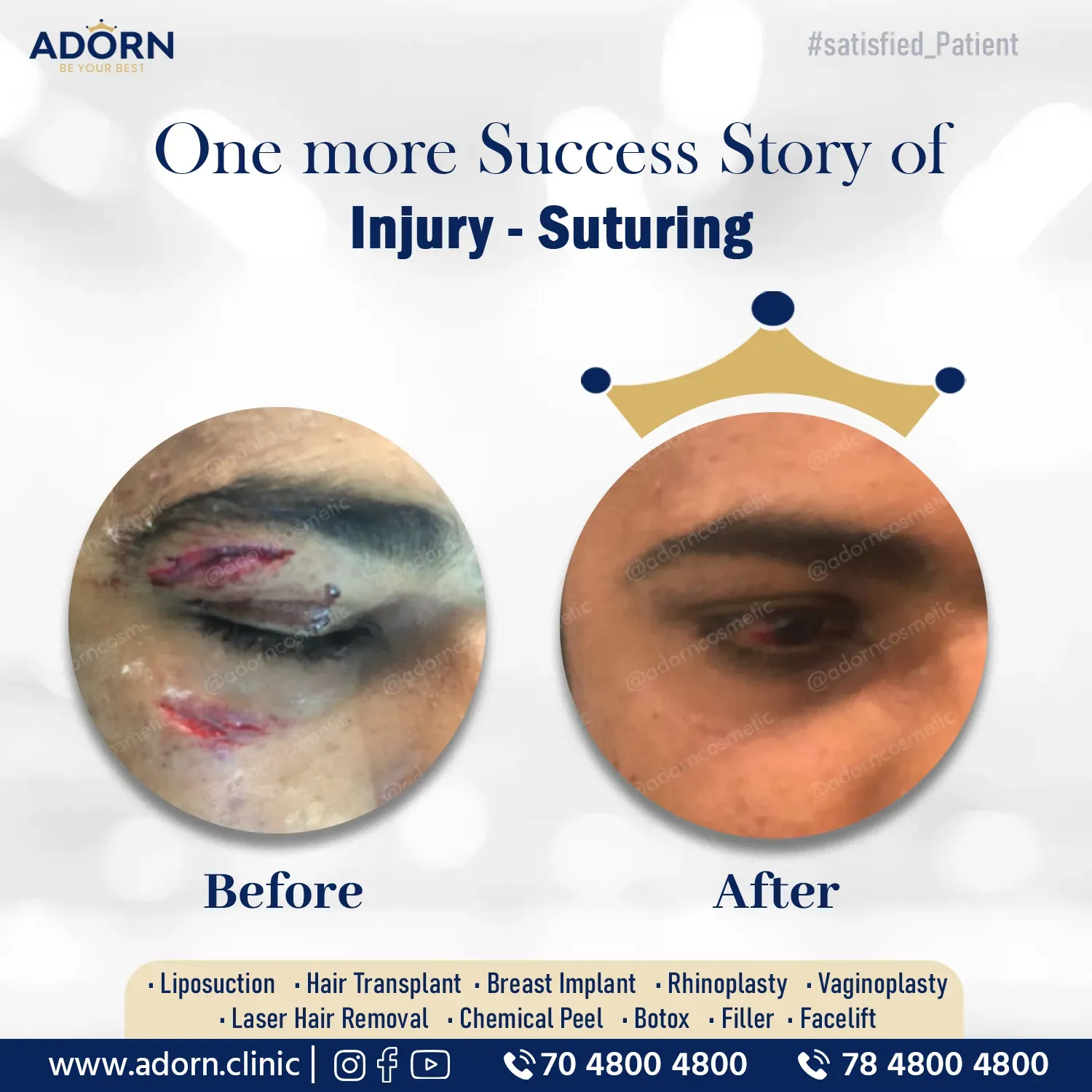 Face Injury | Before and After Plastic Surgery Results | Adorn Clinic