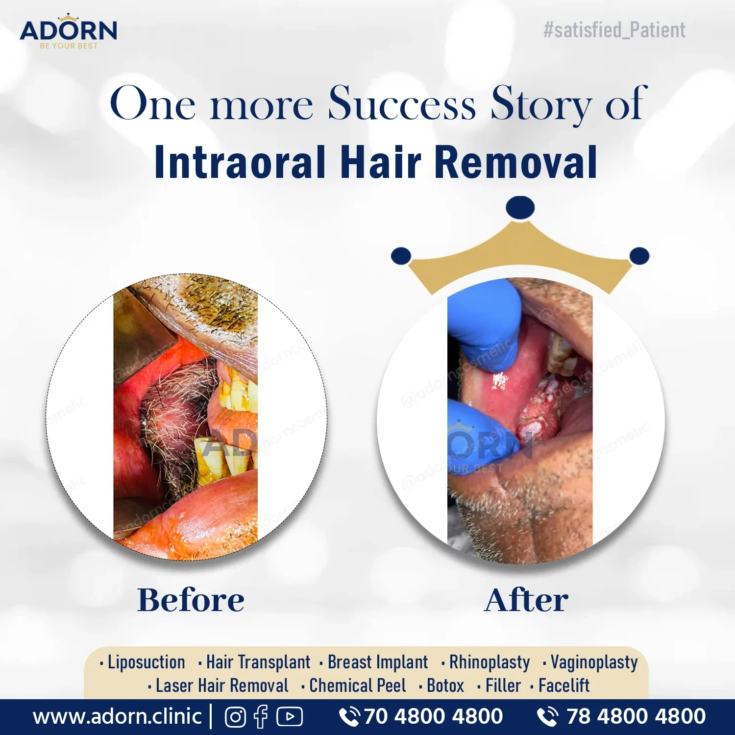 Intra Oral Hair Removal | Before and After Plastic Surgery Results | Adorn Clinic