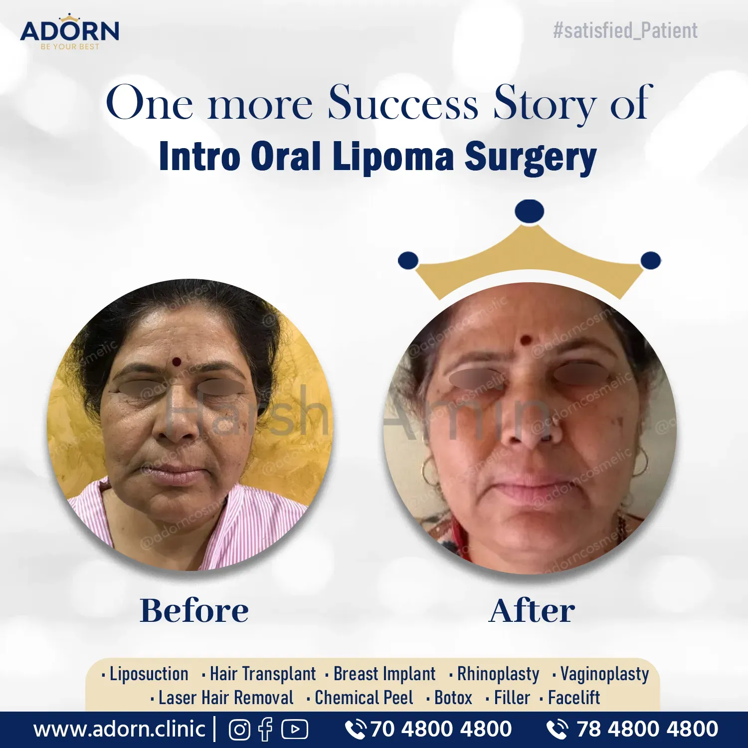 Lipoma | Before and After Plastic Surgery Results | Adorn Clinic