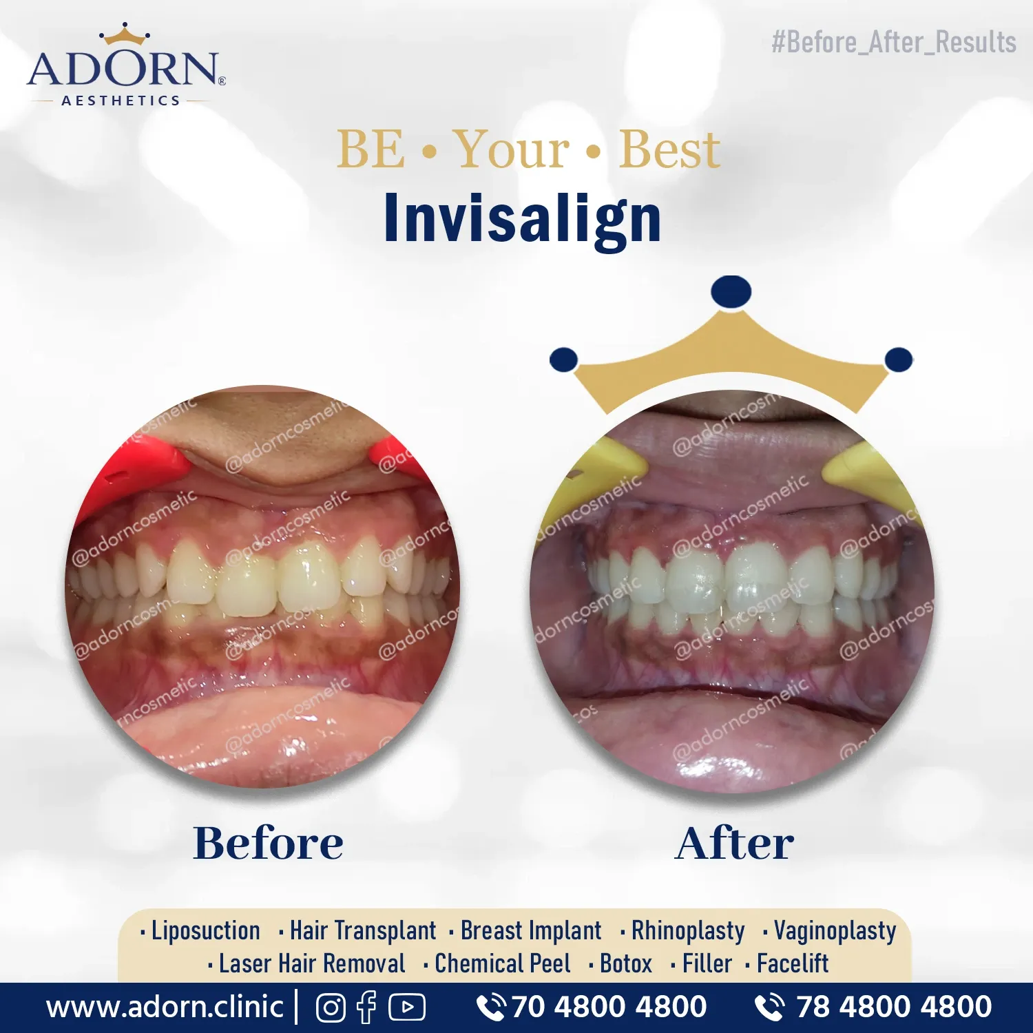 Invisalign dental treatment | Before and After Plastic Surgery Results | Adorn Clinic